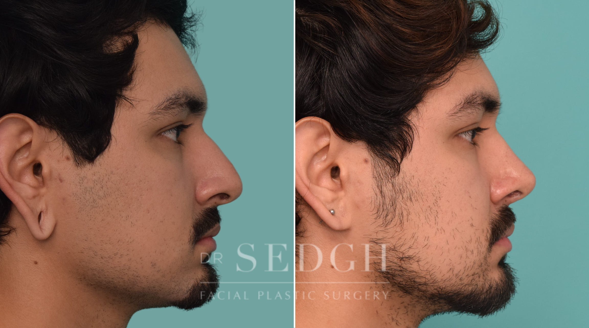 male patient before and after rhinoplasty procedure