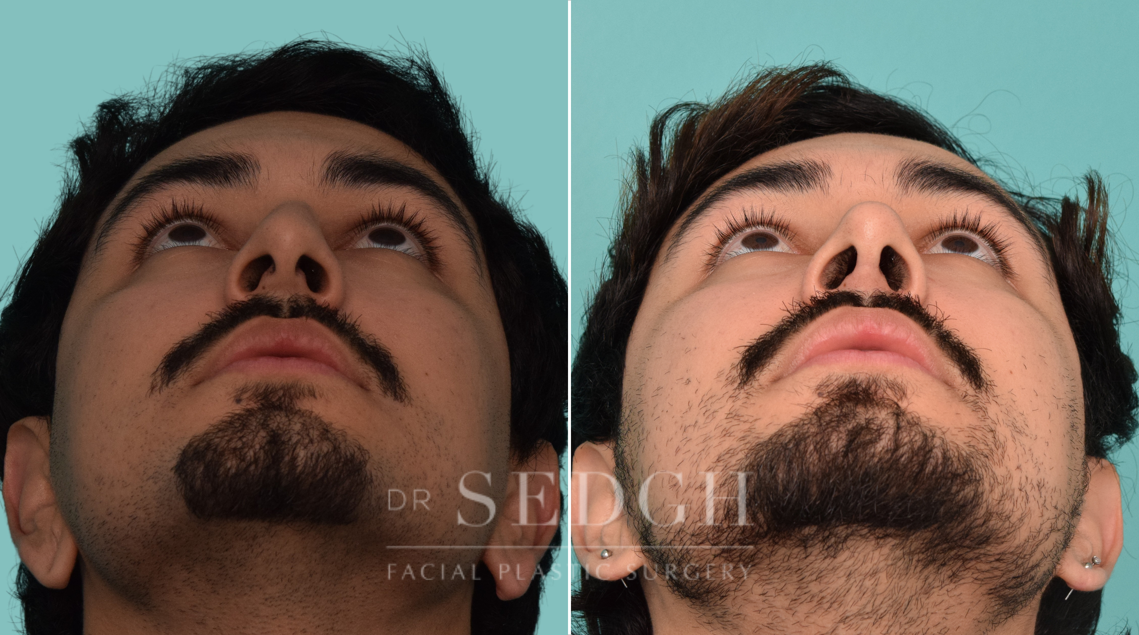 male patient before and after rhinoplasty procedure