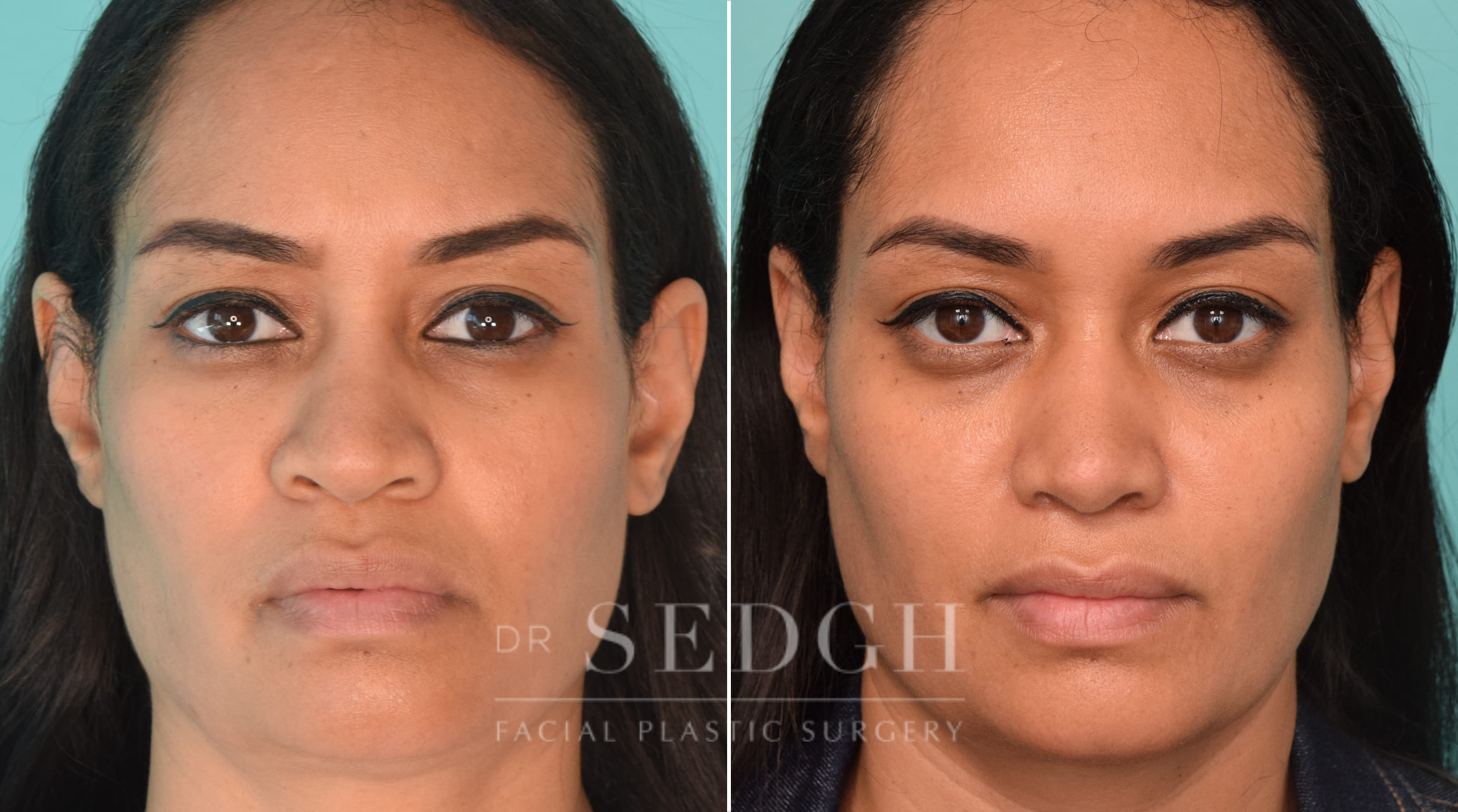 female patient before and after rhinoplasty procedure