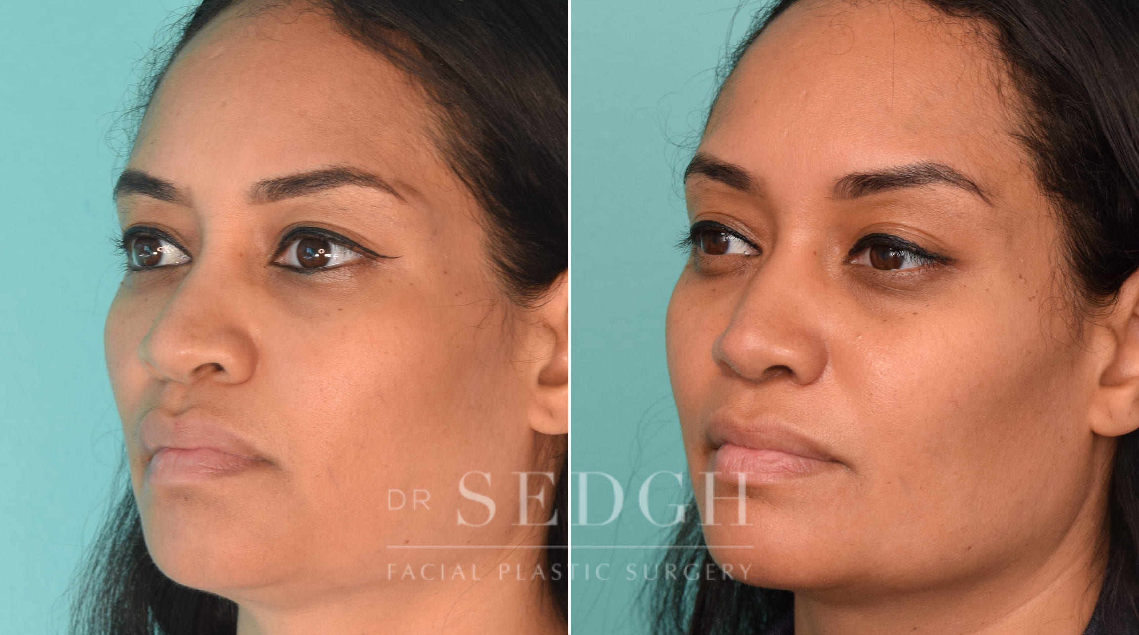 female patient before and after rhinoplasty procedure