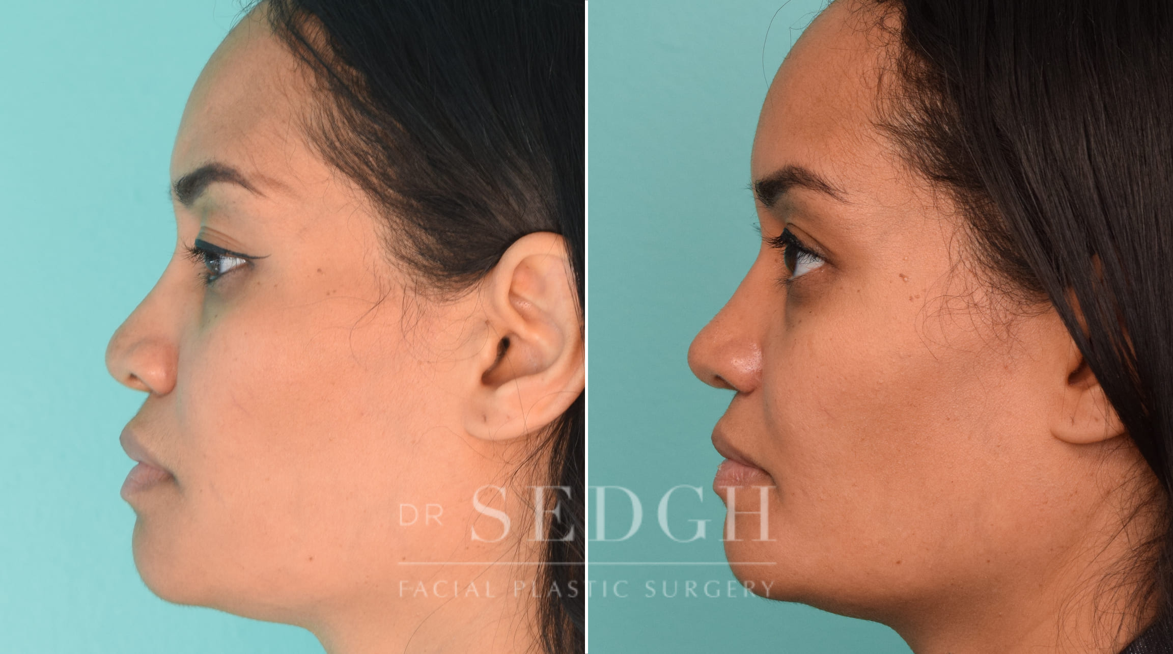 female patient before and after rhinoplasty procedure