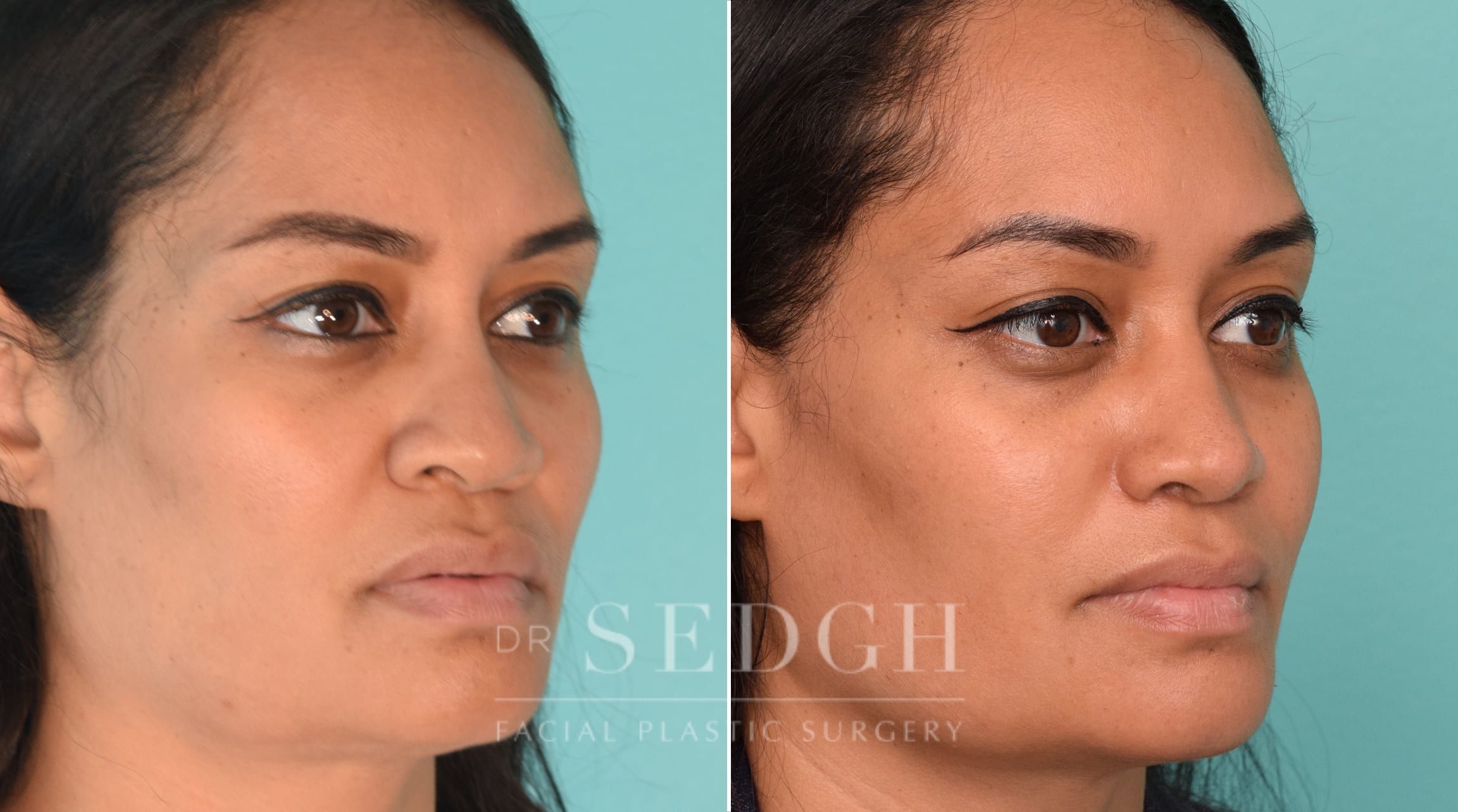 female patient before and after rhinoplasty procedure