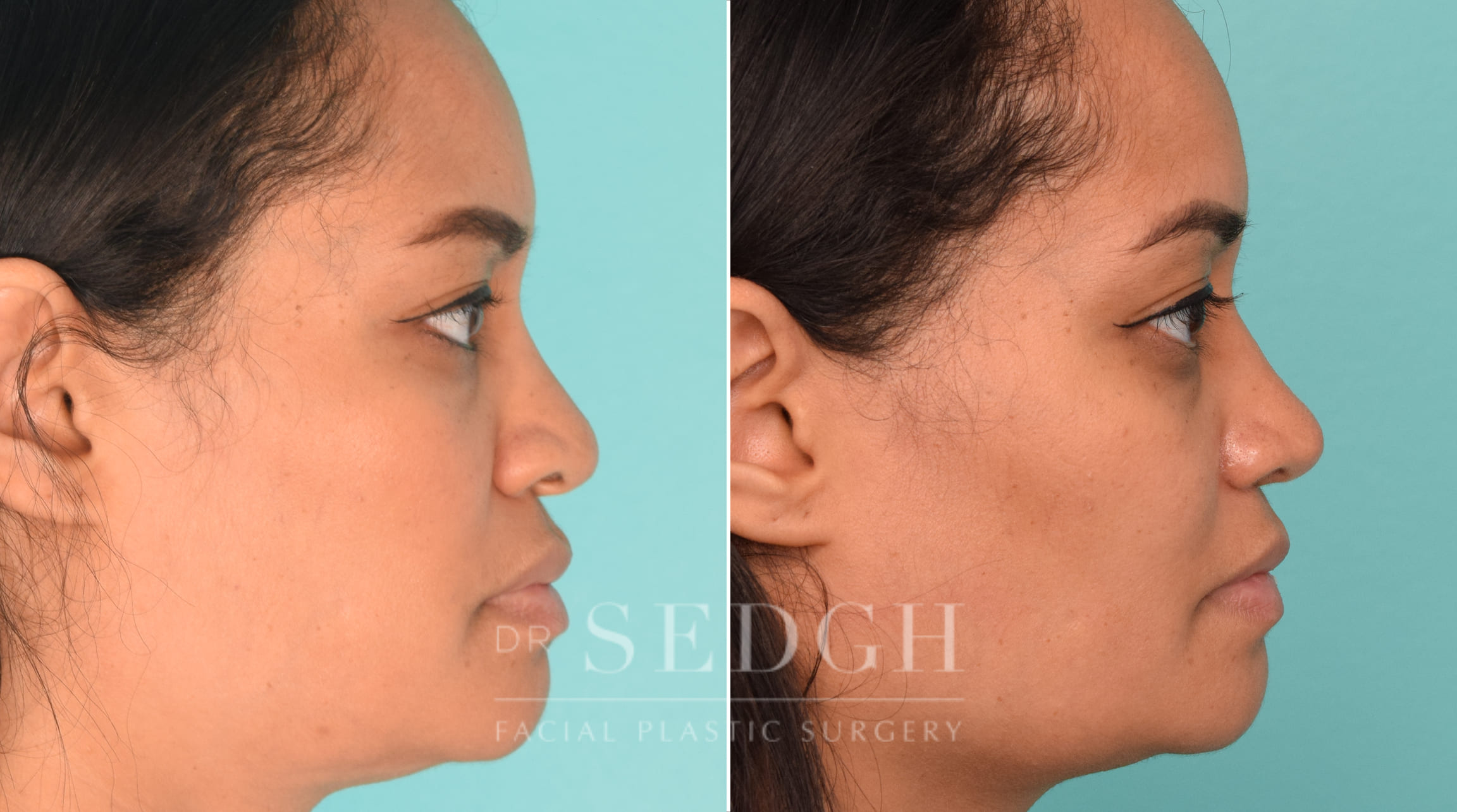 female patient before and after rhinoplasty procedure