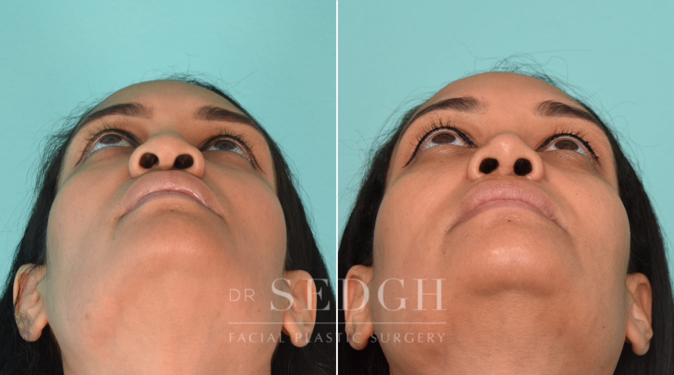 female patient before and after rhinoplasty procedure