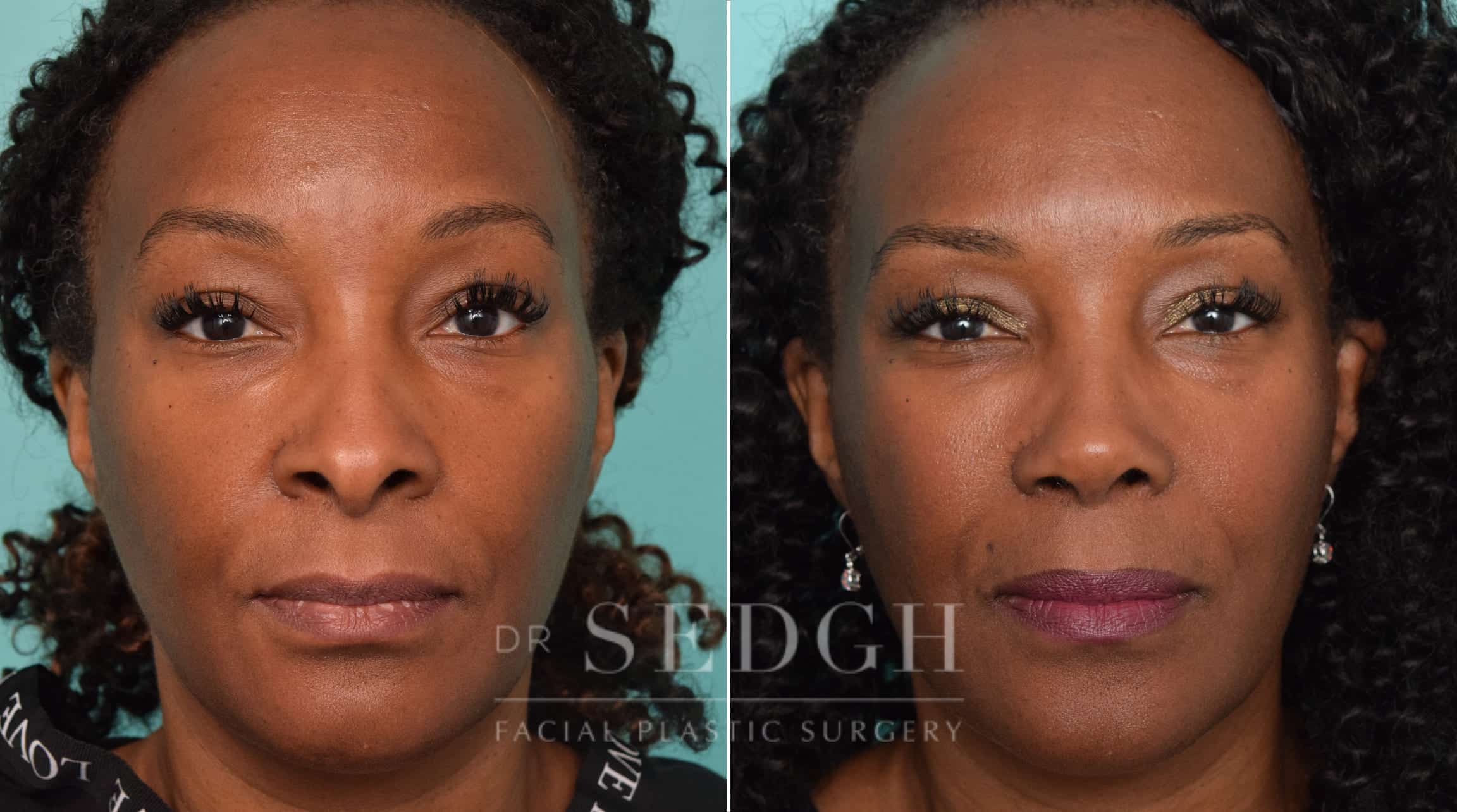 female patient before and after rhinoplasty procedure