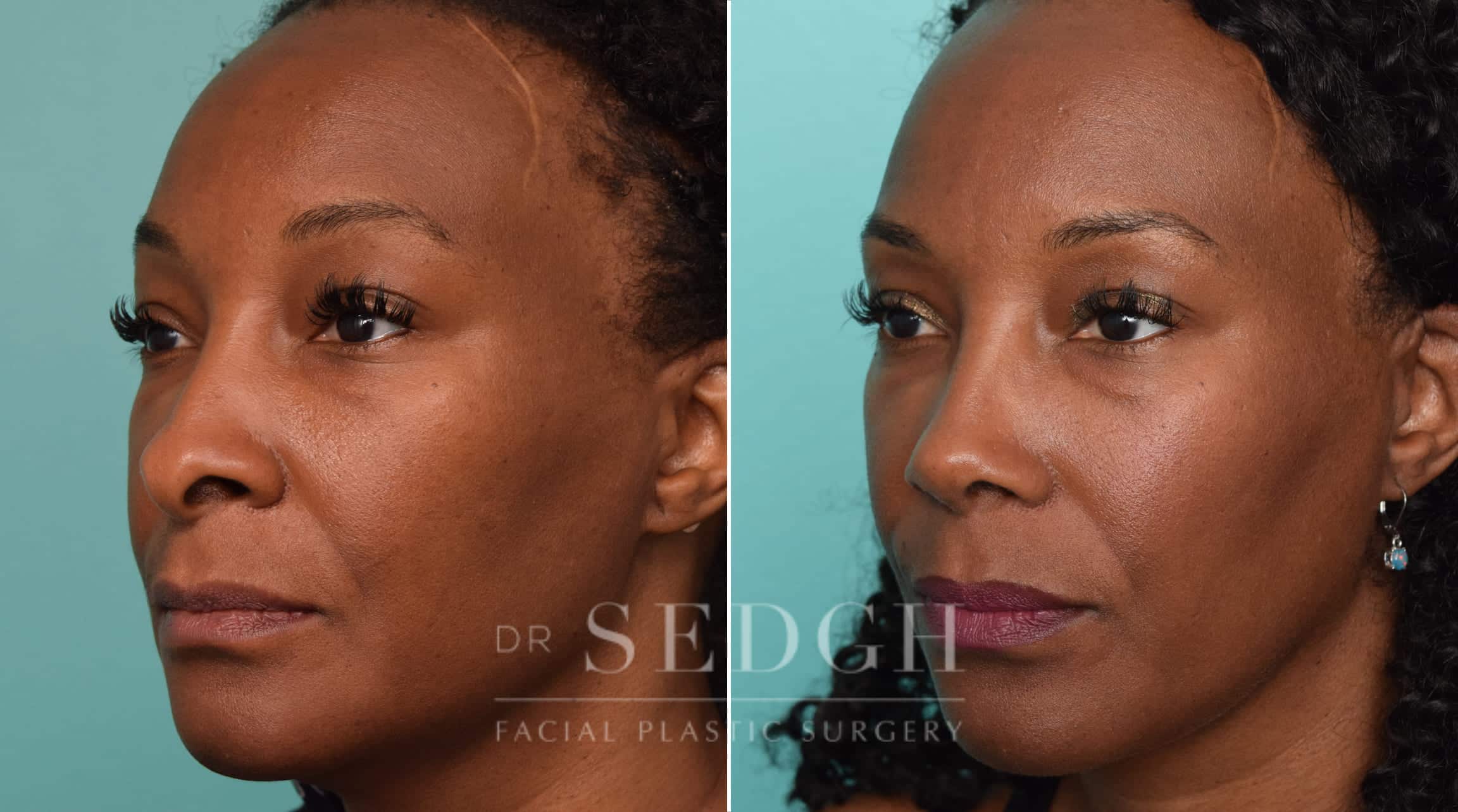 female patient before and after rhinoplasty procedure