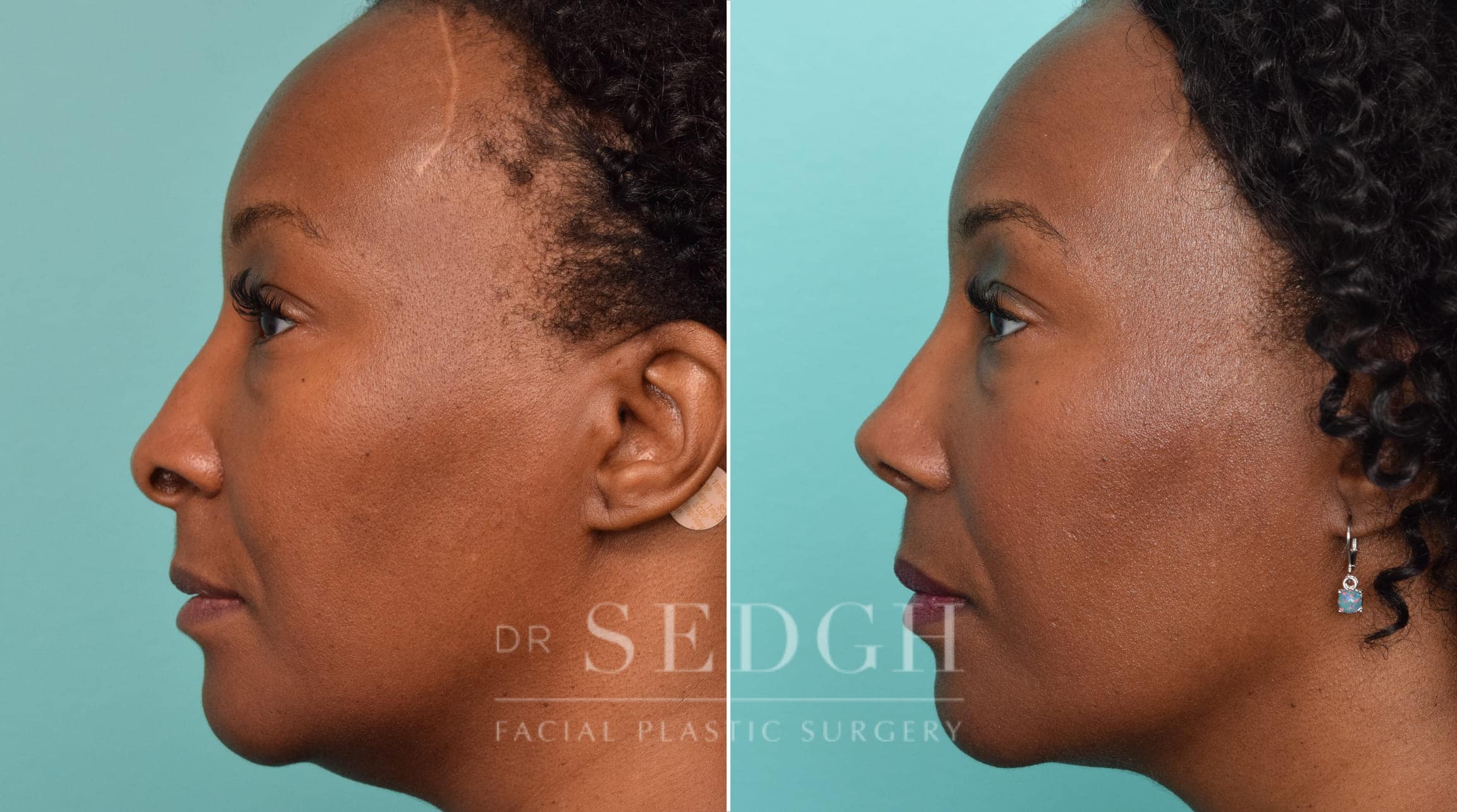 female patient before and after rhinoplasty procedure