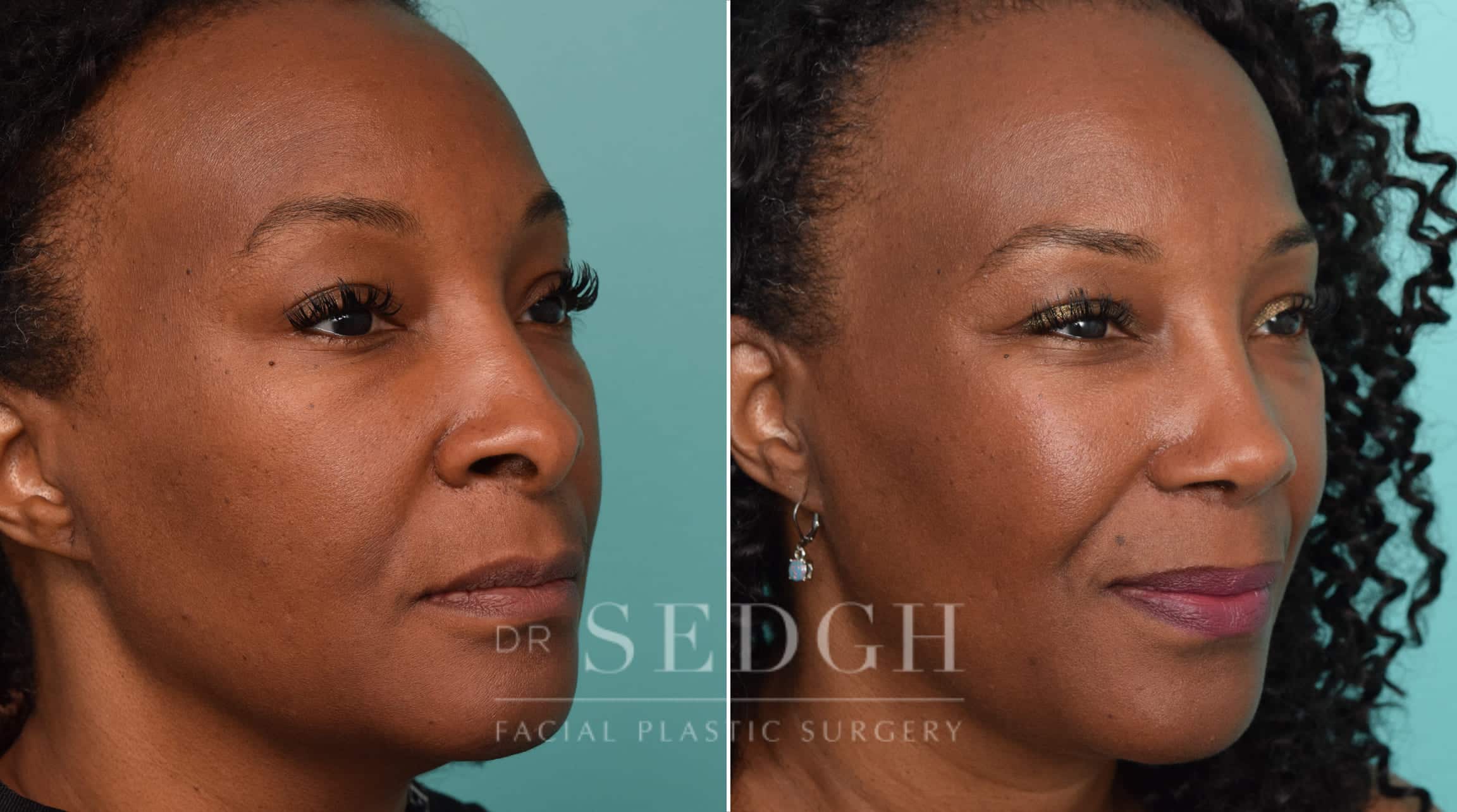 female patient before and after rhinoplasty procedure