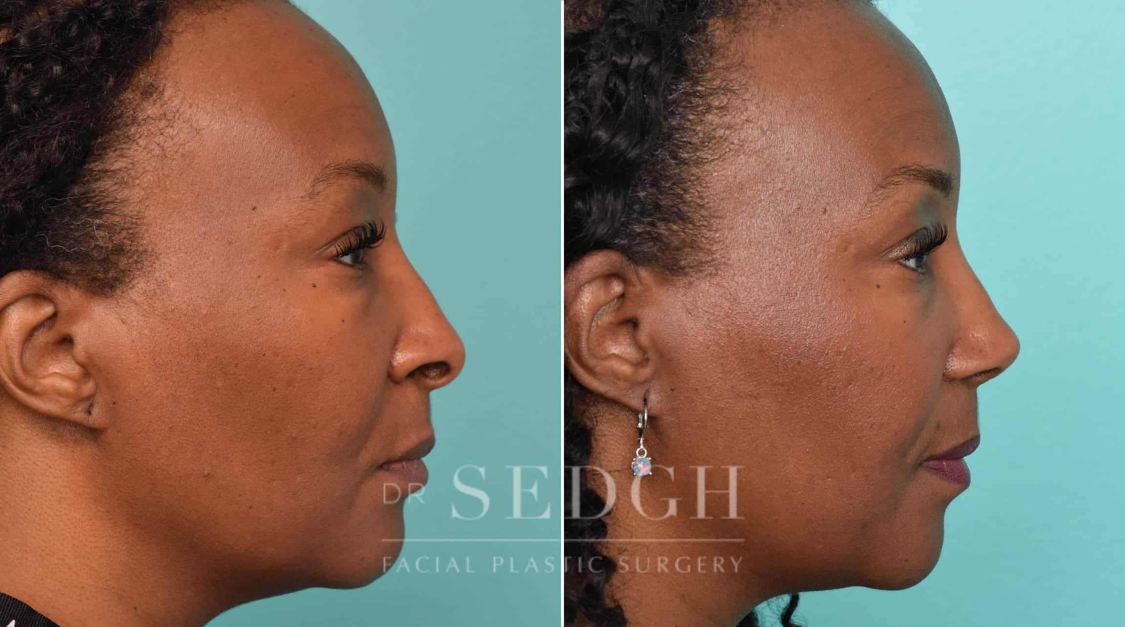 female patient before and after rhinoplasty procedure