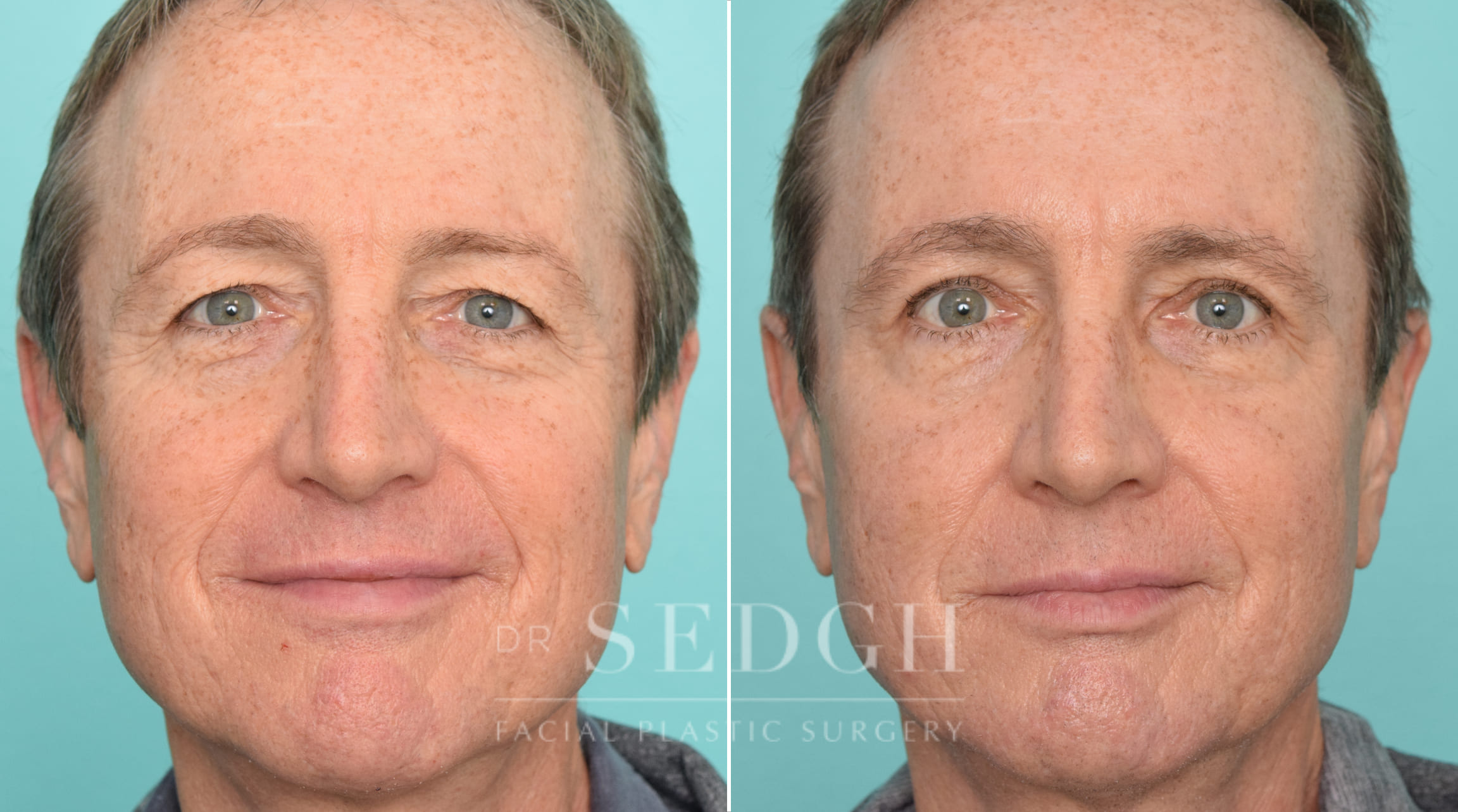 Male Patient Before and After Brow Lift | Sedgh