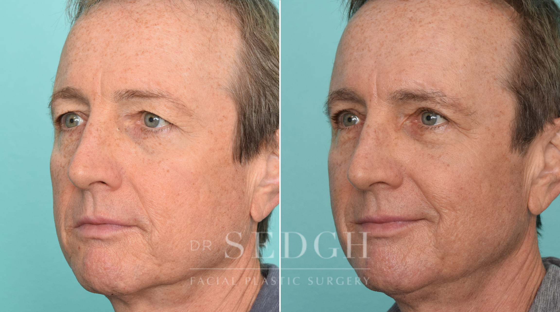 Male Patient Before and After Brow Lift | Sedgh