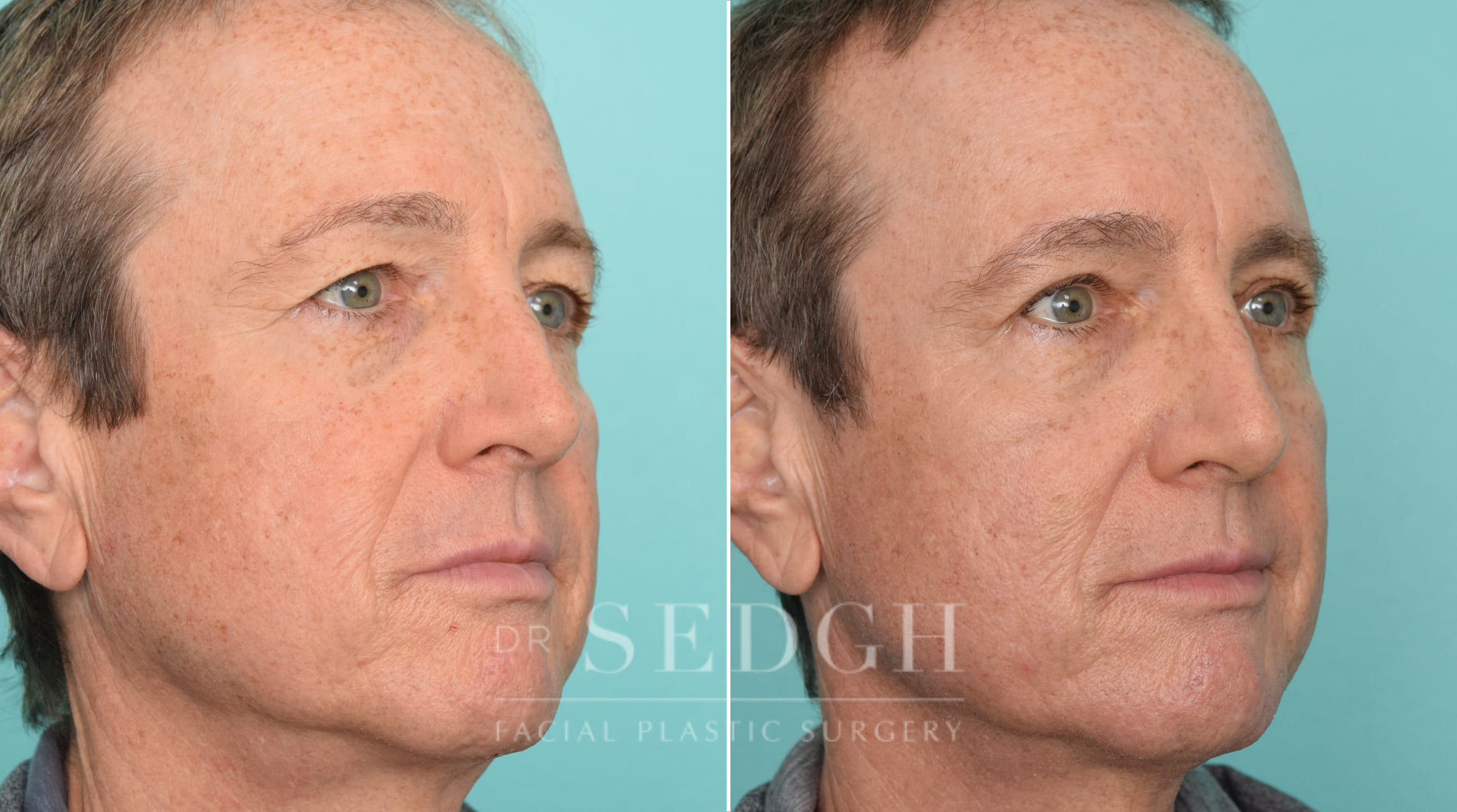 Male Patient Before and After Brow Lift | Sedgh