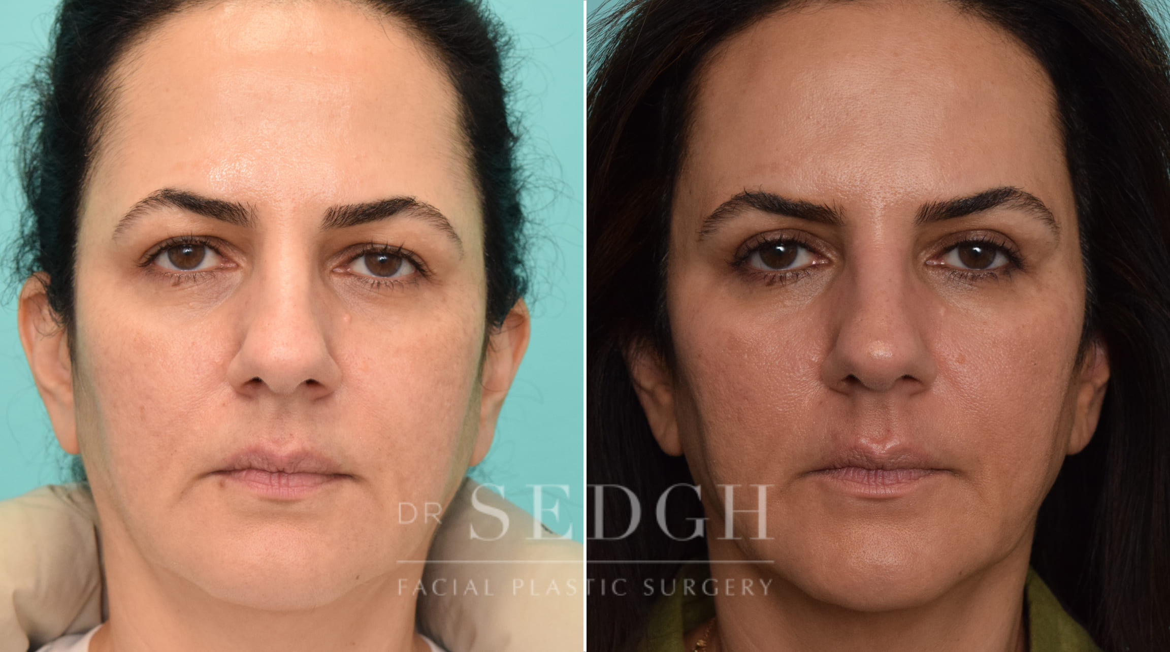 Female Patient Before and After Brow Lift | Sedgh