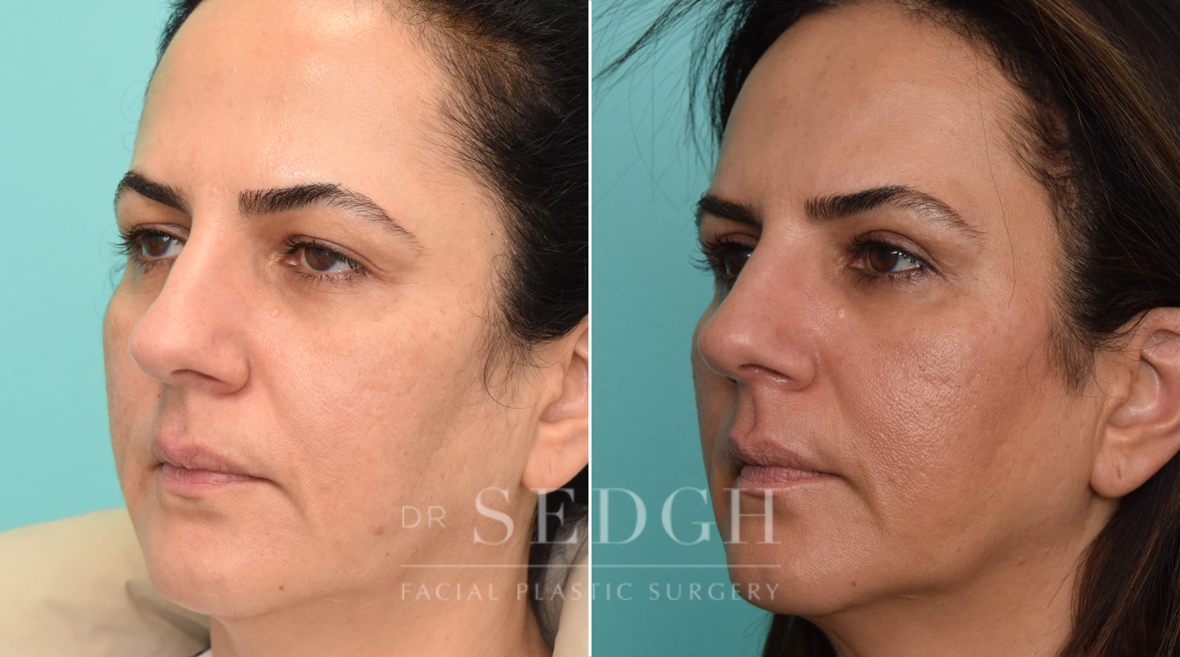 Female Patient Before and After Brow Lift | Sedgh