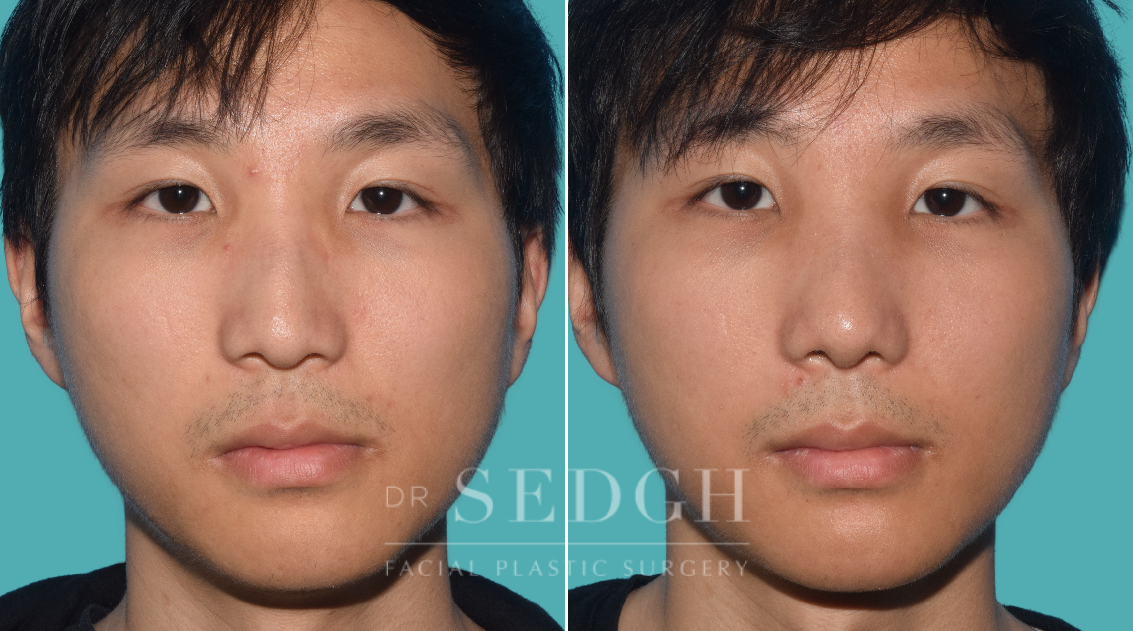 male patient before and after rhinoplasty | Sedgh