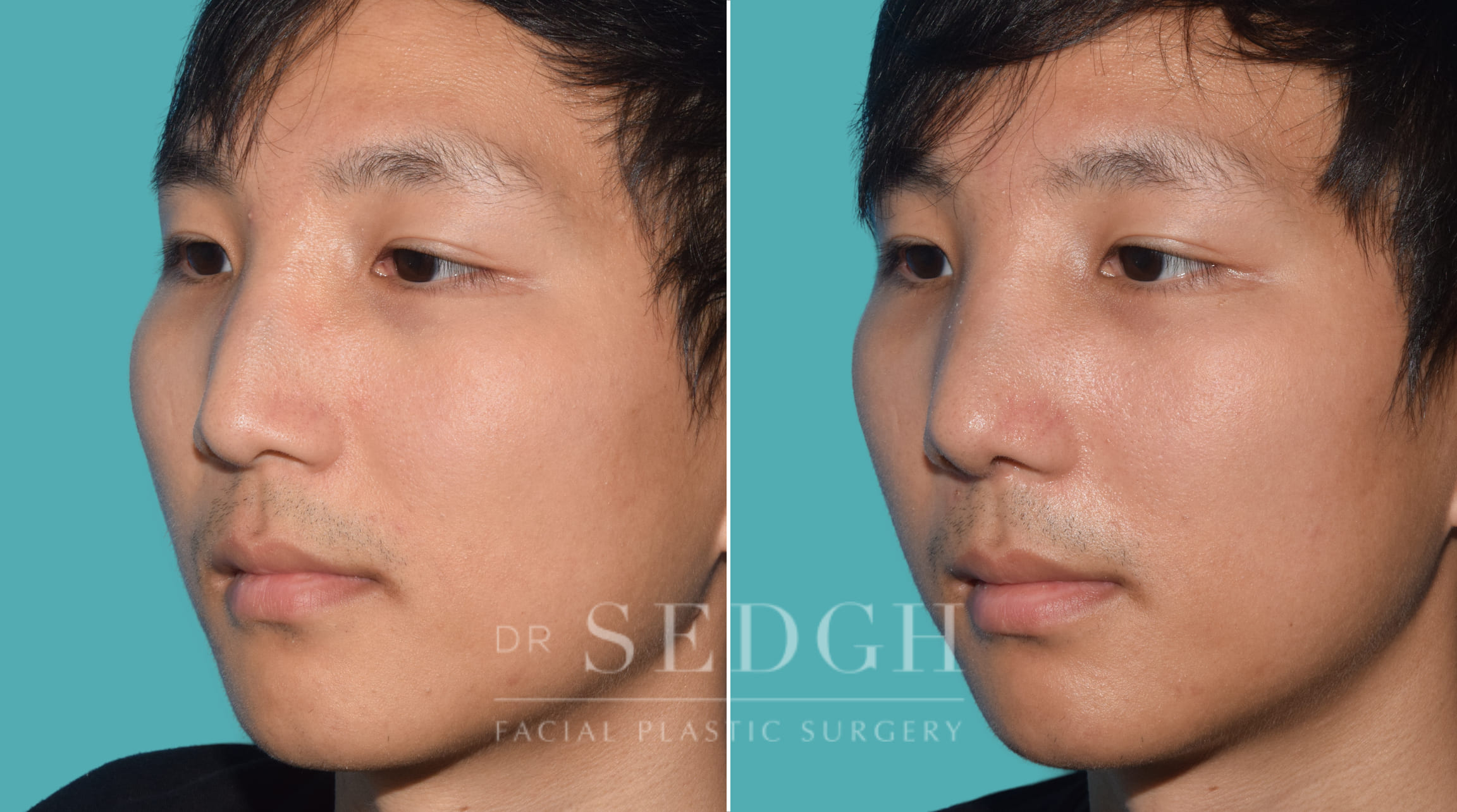 male patient before and after rhinoplasty | Sedgh