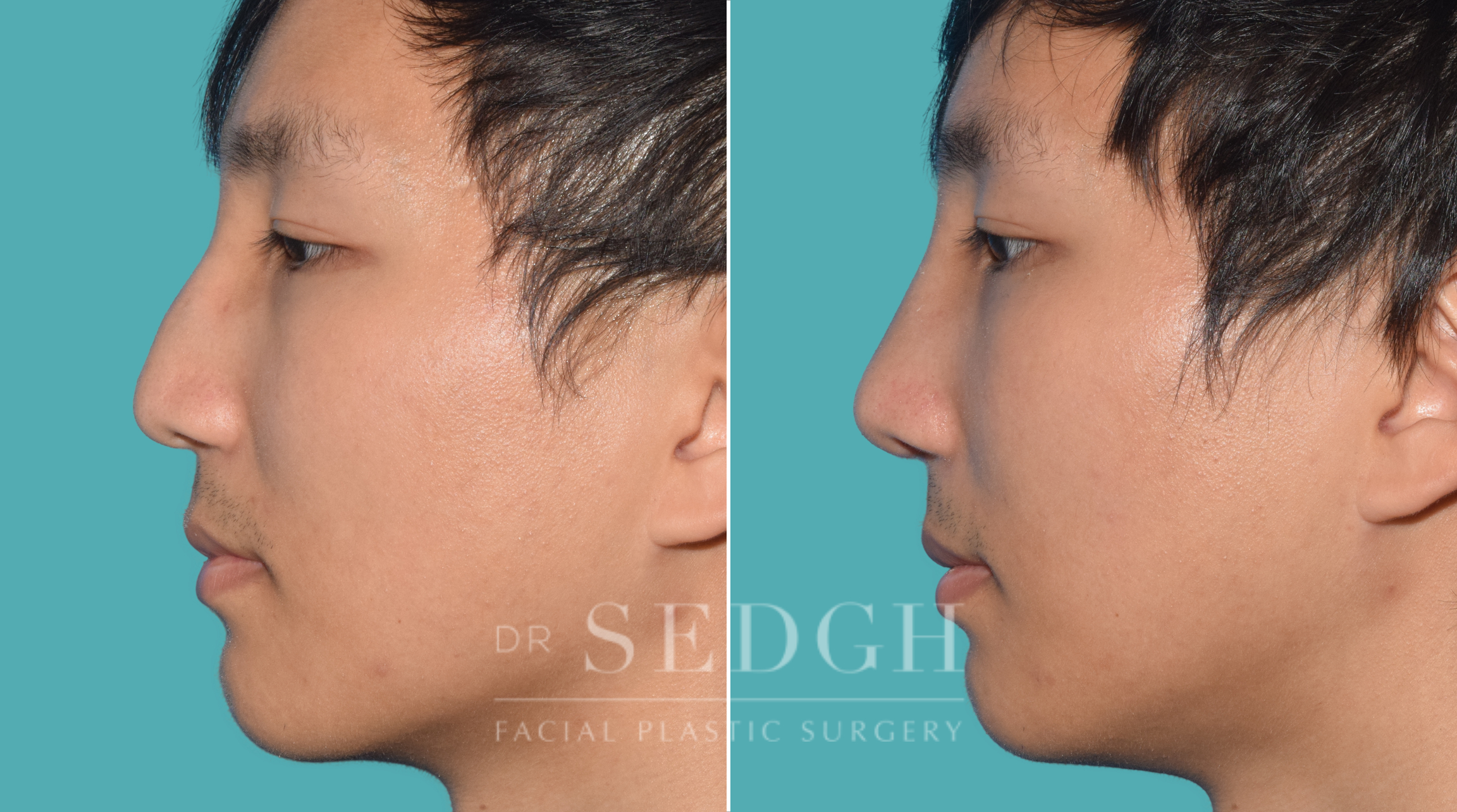 male patient before and after rhinoplasty | Sedgh