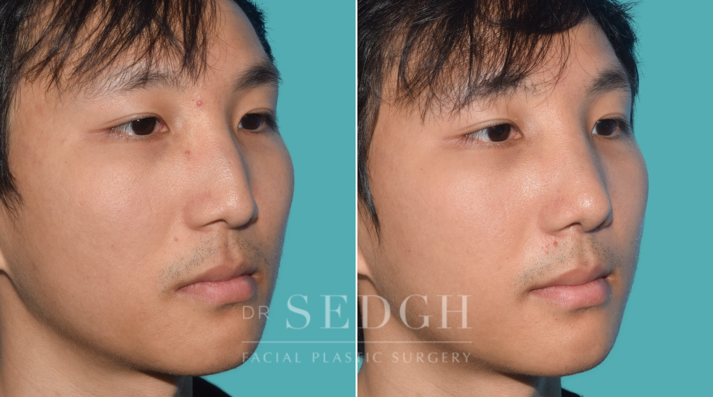 male patient before and after rhinoplasty | Sedgh