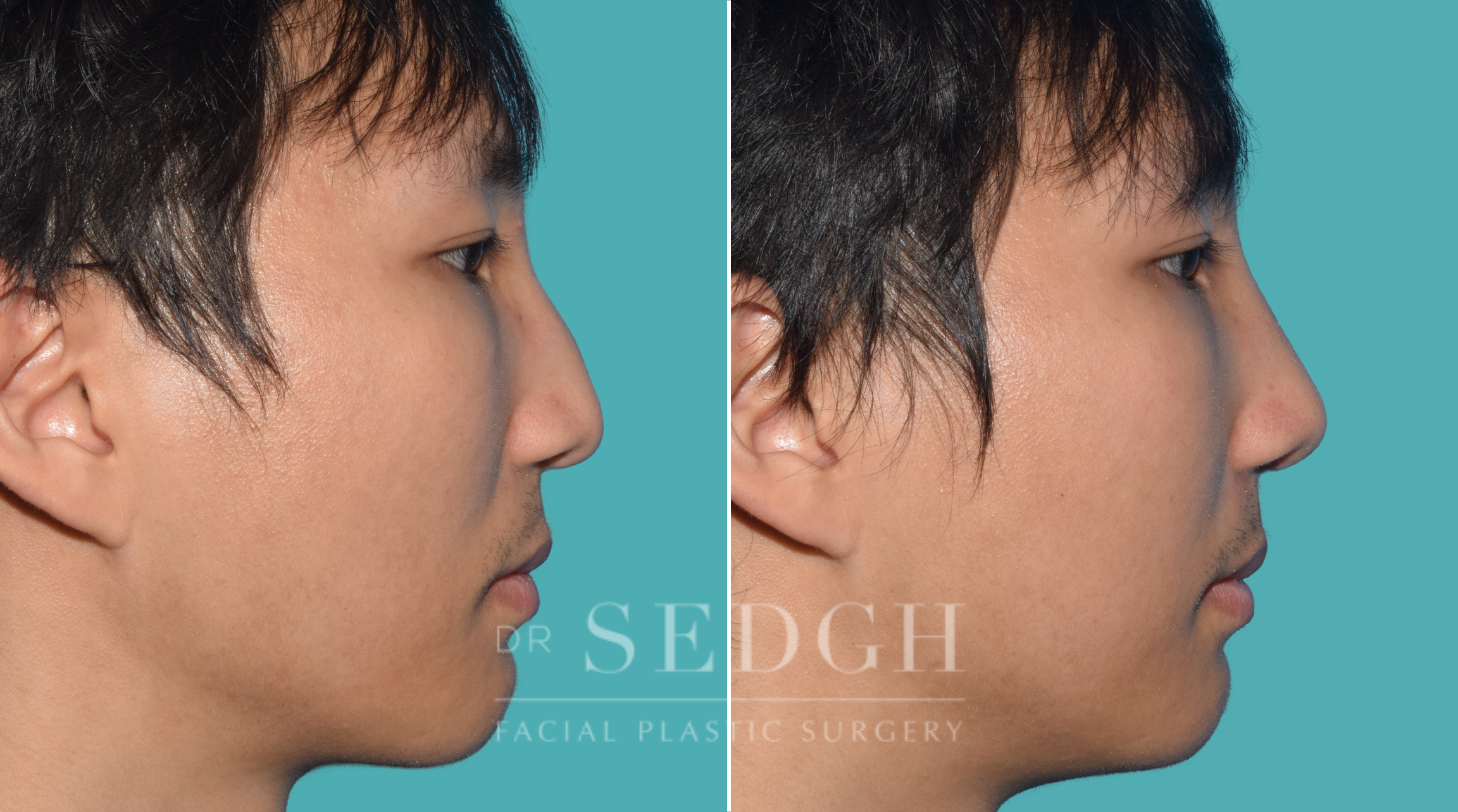 male patient before and after rhinoplasty | Sedgh