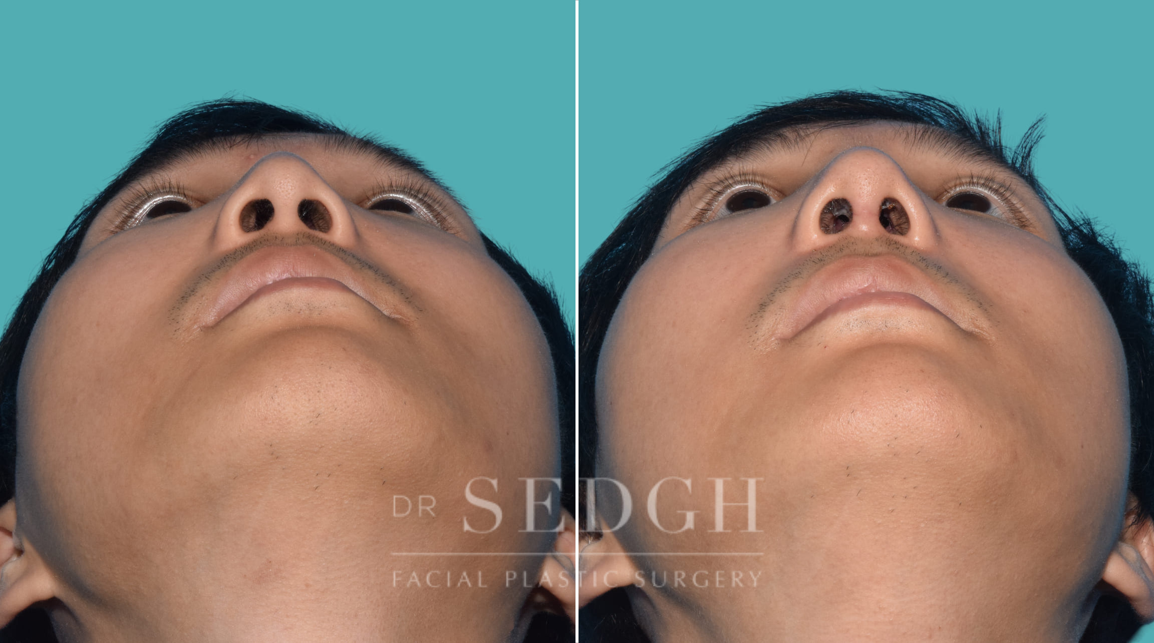 male patient before and after rhinoplasty | Sedgh