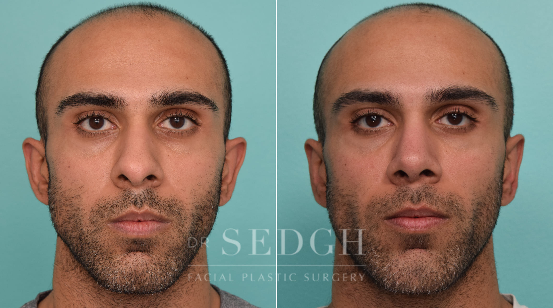 male patient before and after rhinoplasty procedure