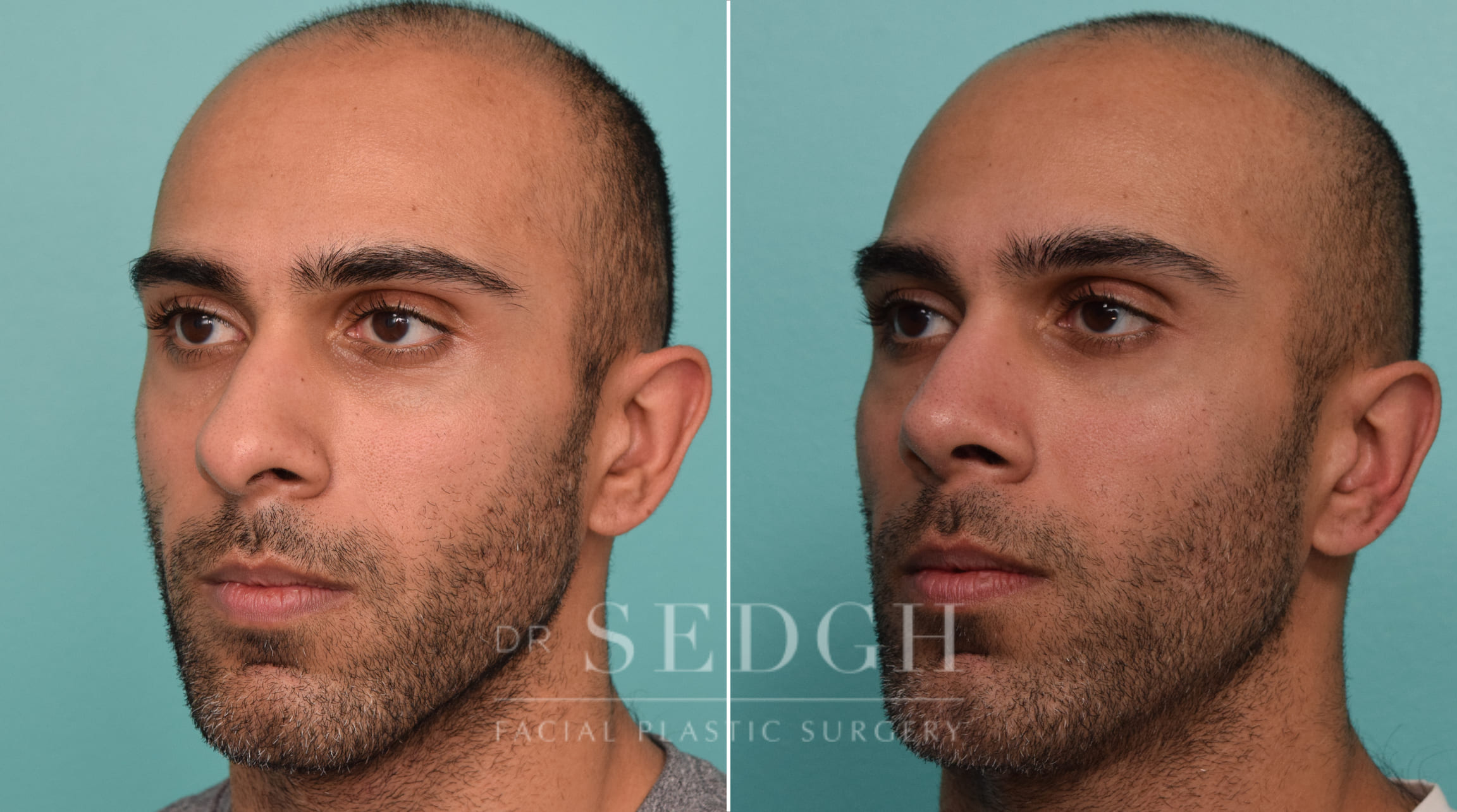 male patient before and after rhinoplasty procedure