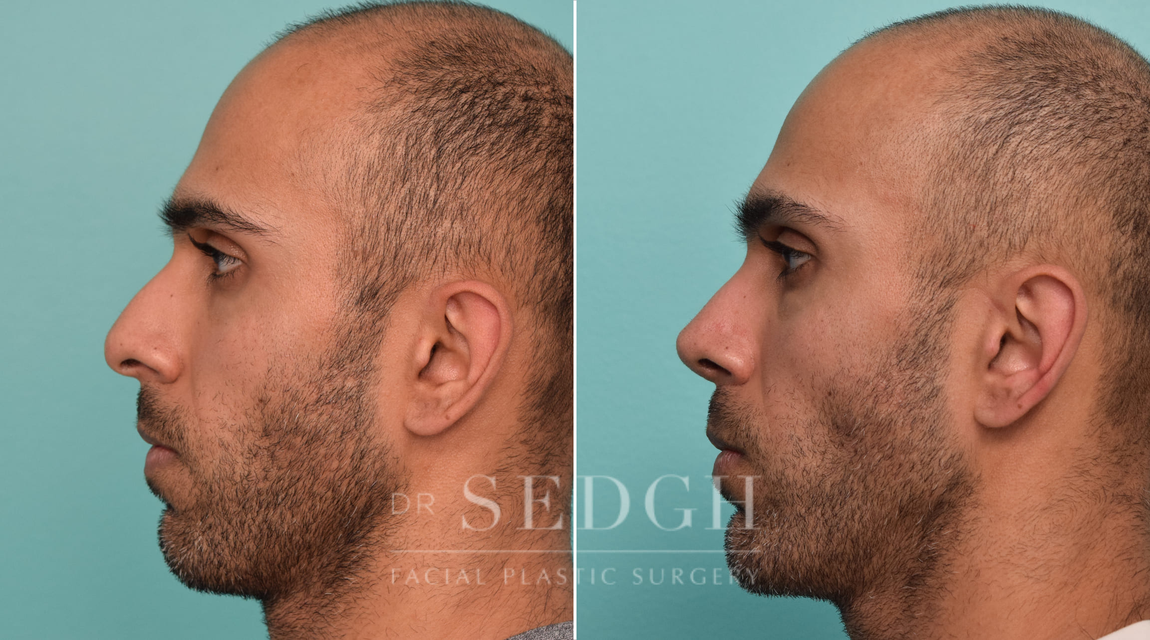 male patient before and after rhinoplasty procedure