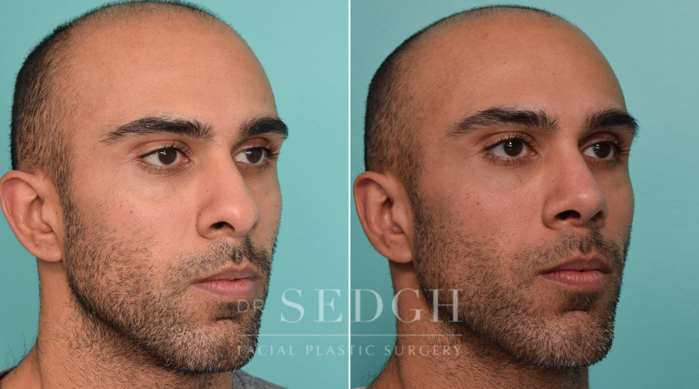 male patient before and after rhinoplasty procedure