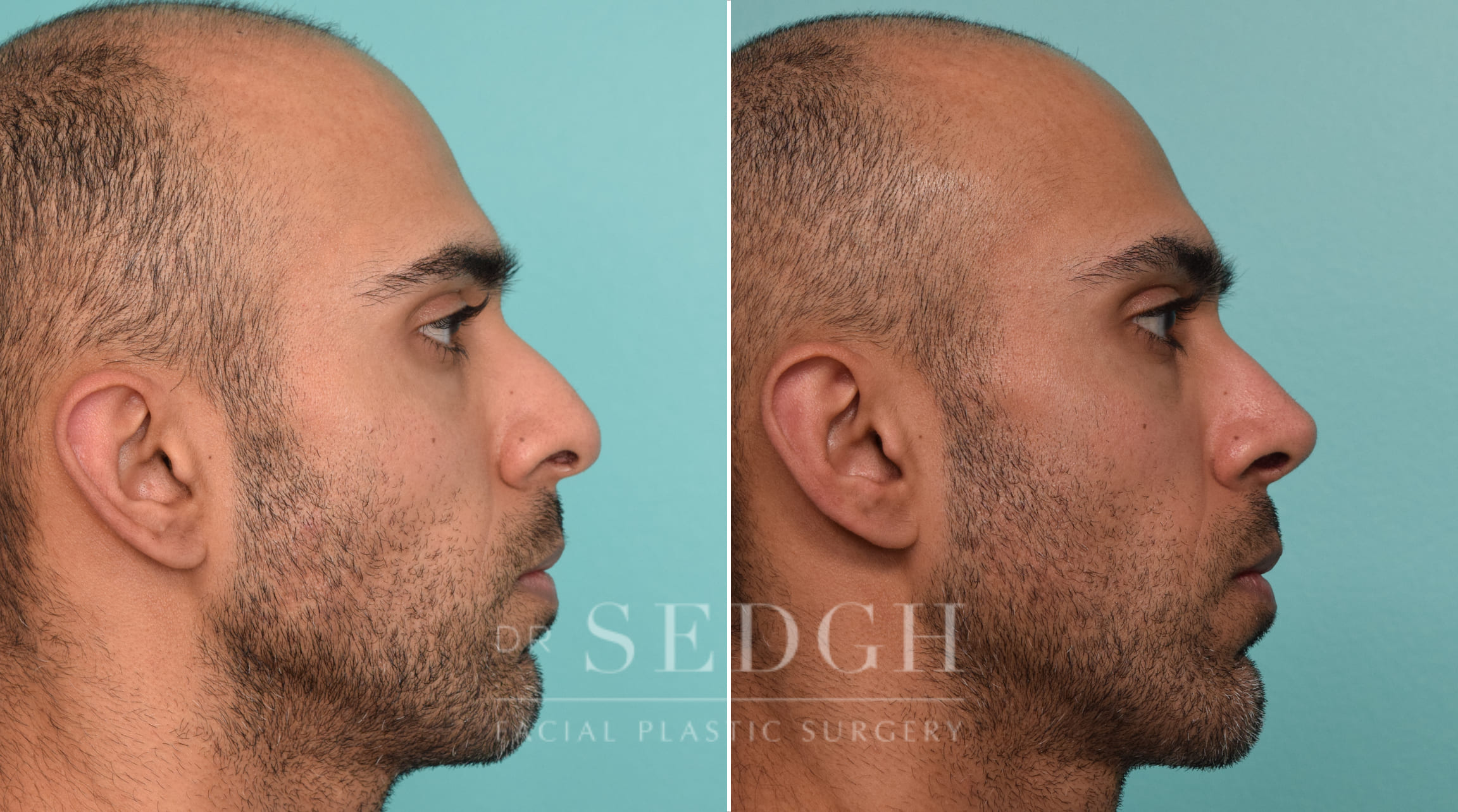 male patient before and after rhinoplasty procedure