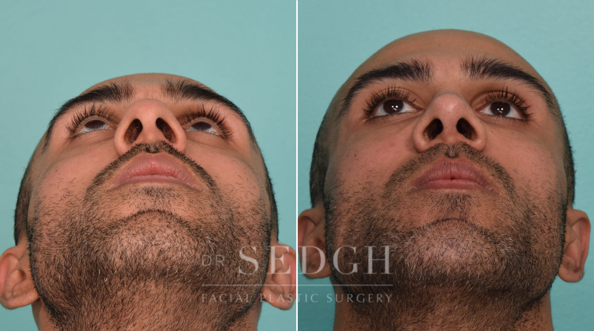 male patient before and after rhinoplasty procedure