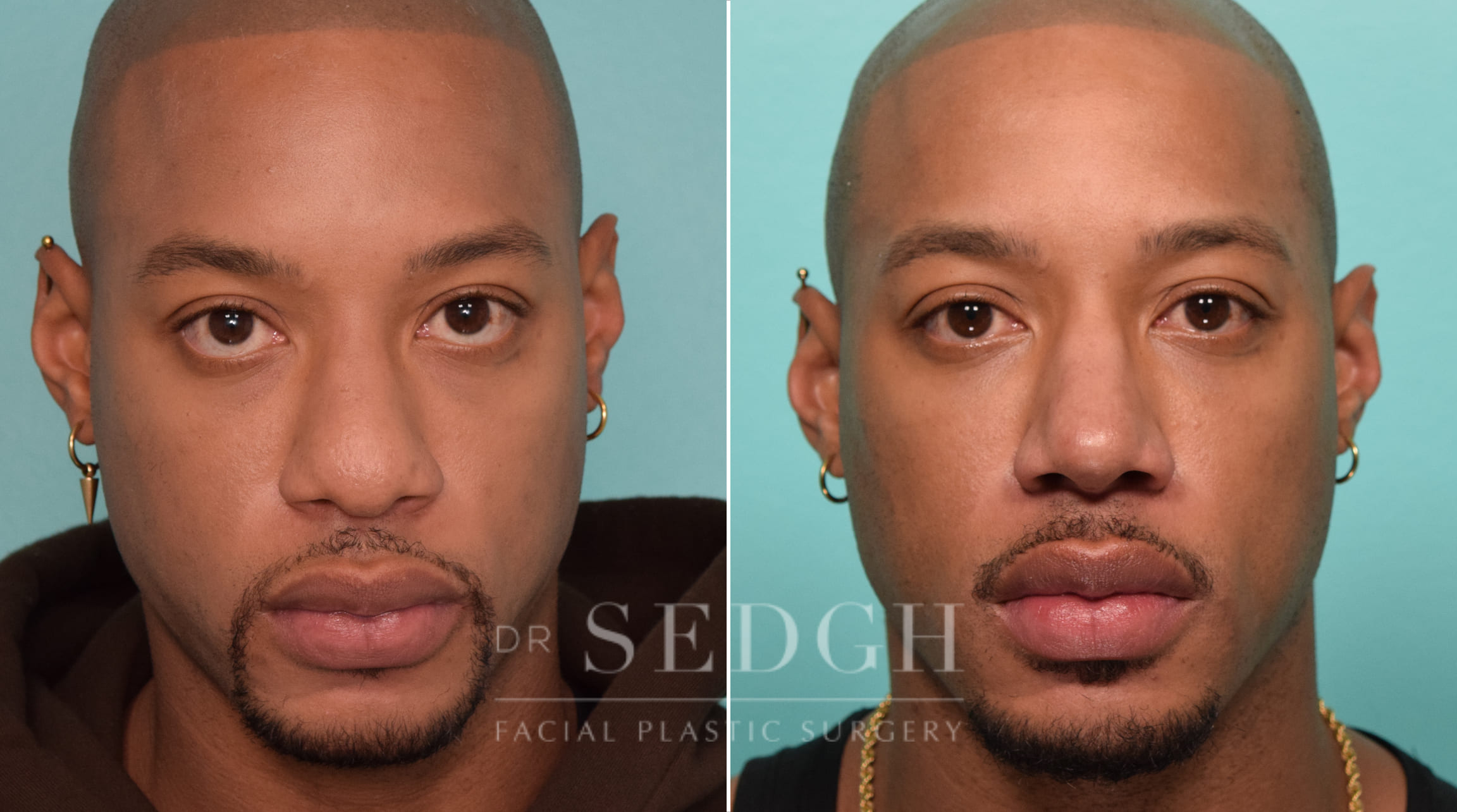 patient before and after rhinoplasty procedure