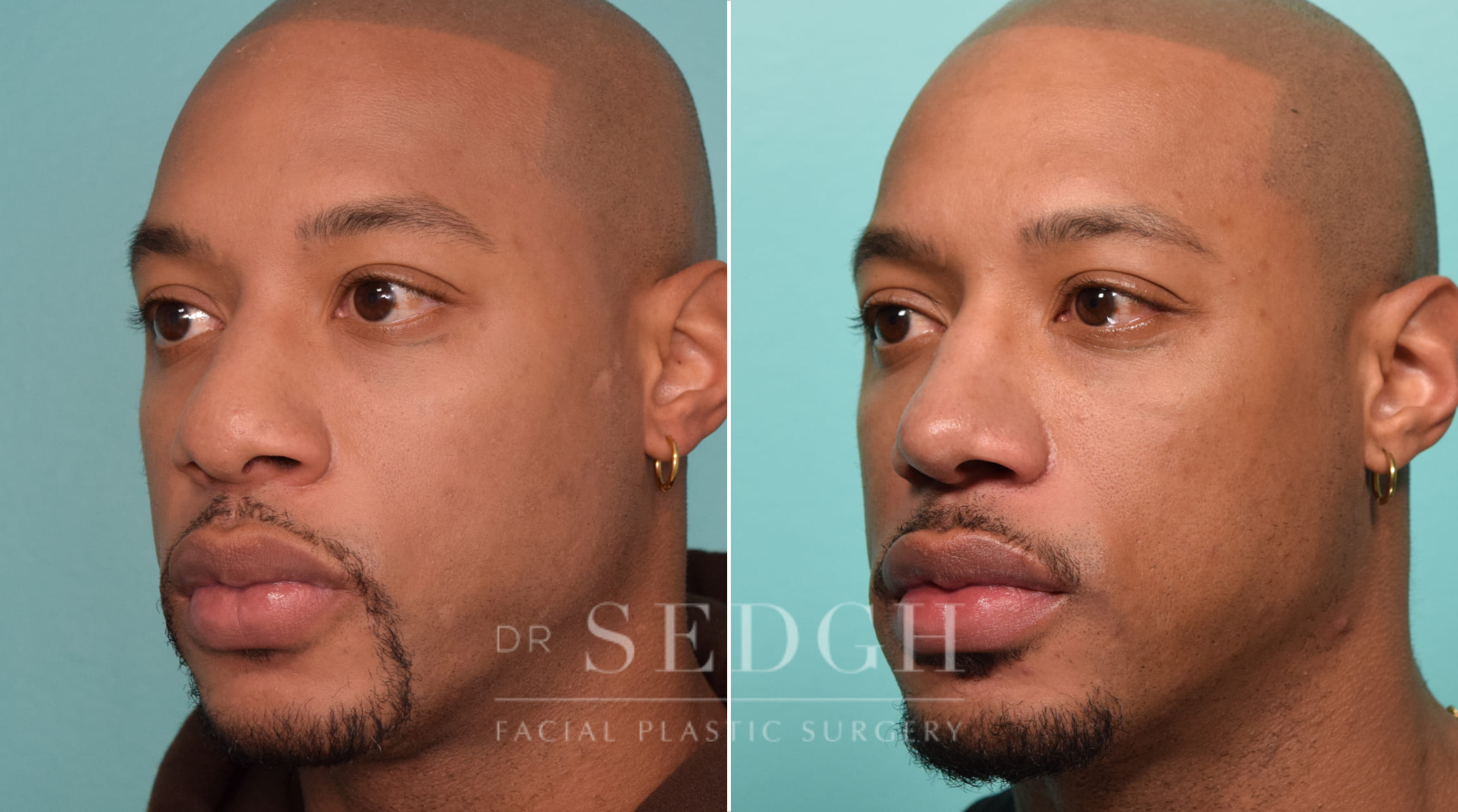 patient before and after rhinoplasty procedure