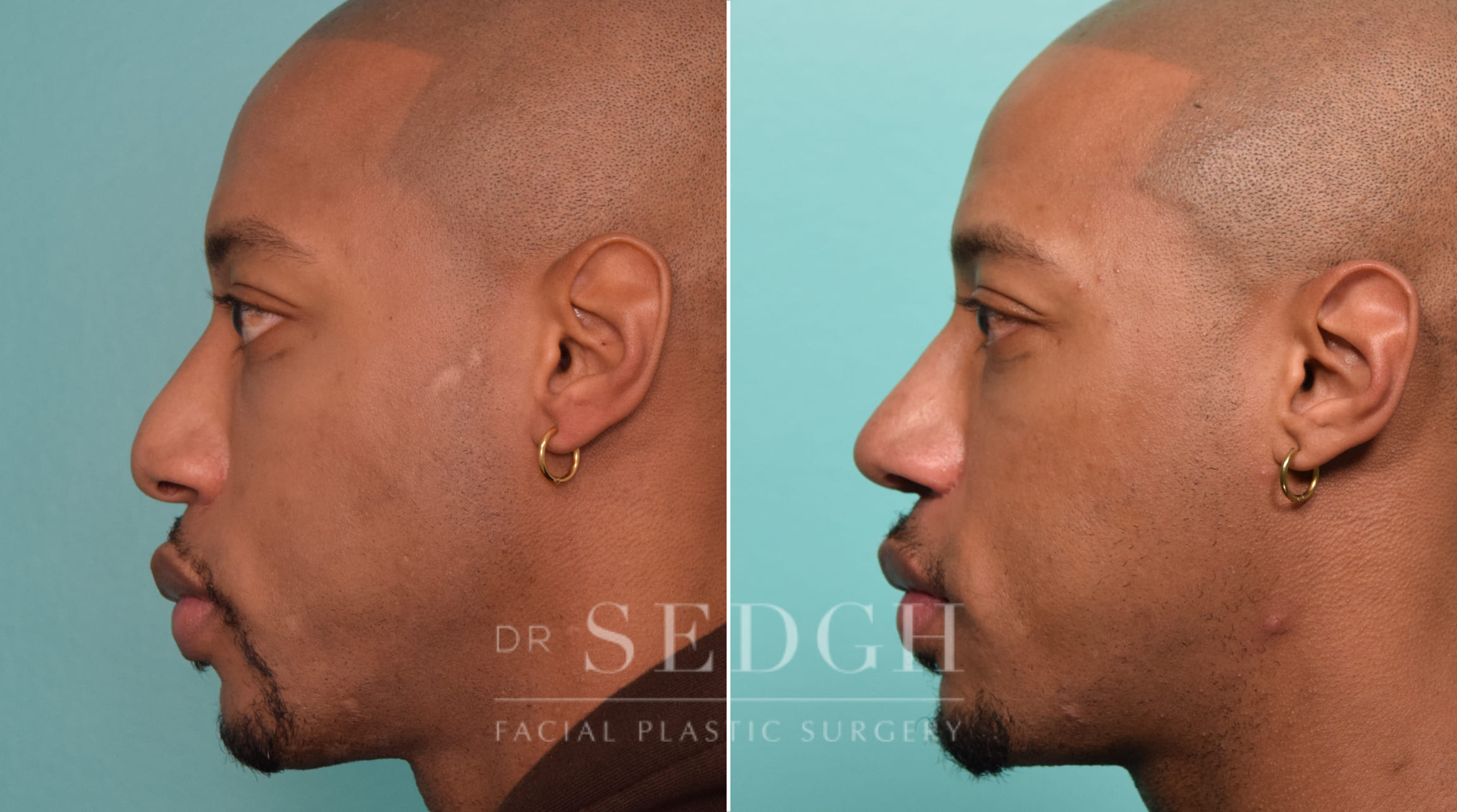 patient before and after rhinoplasty procedure