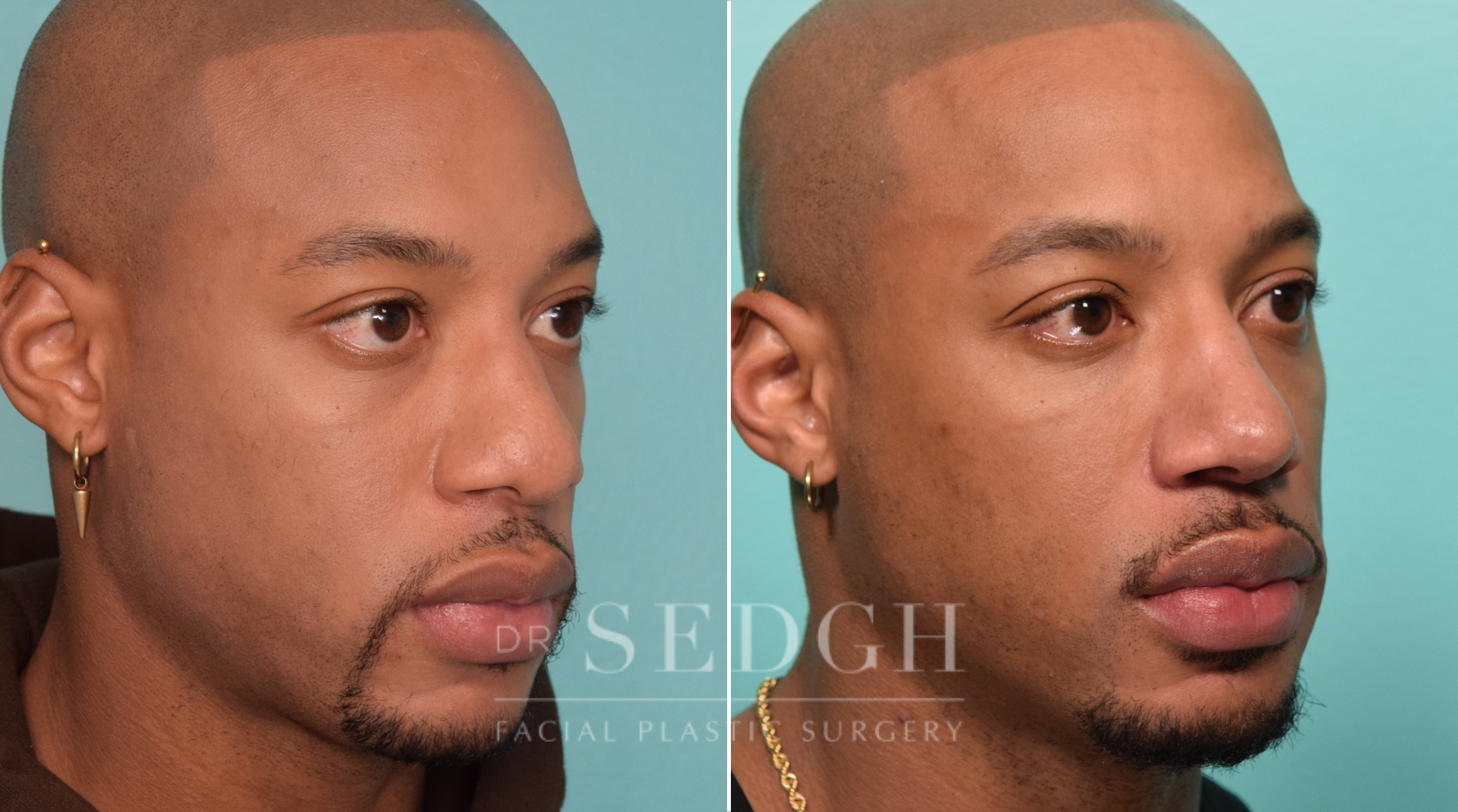 patient before and after rhinoplasty procedure