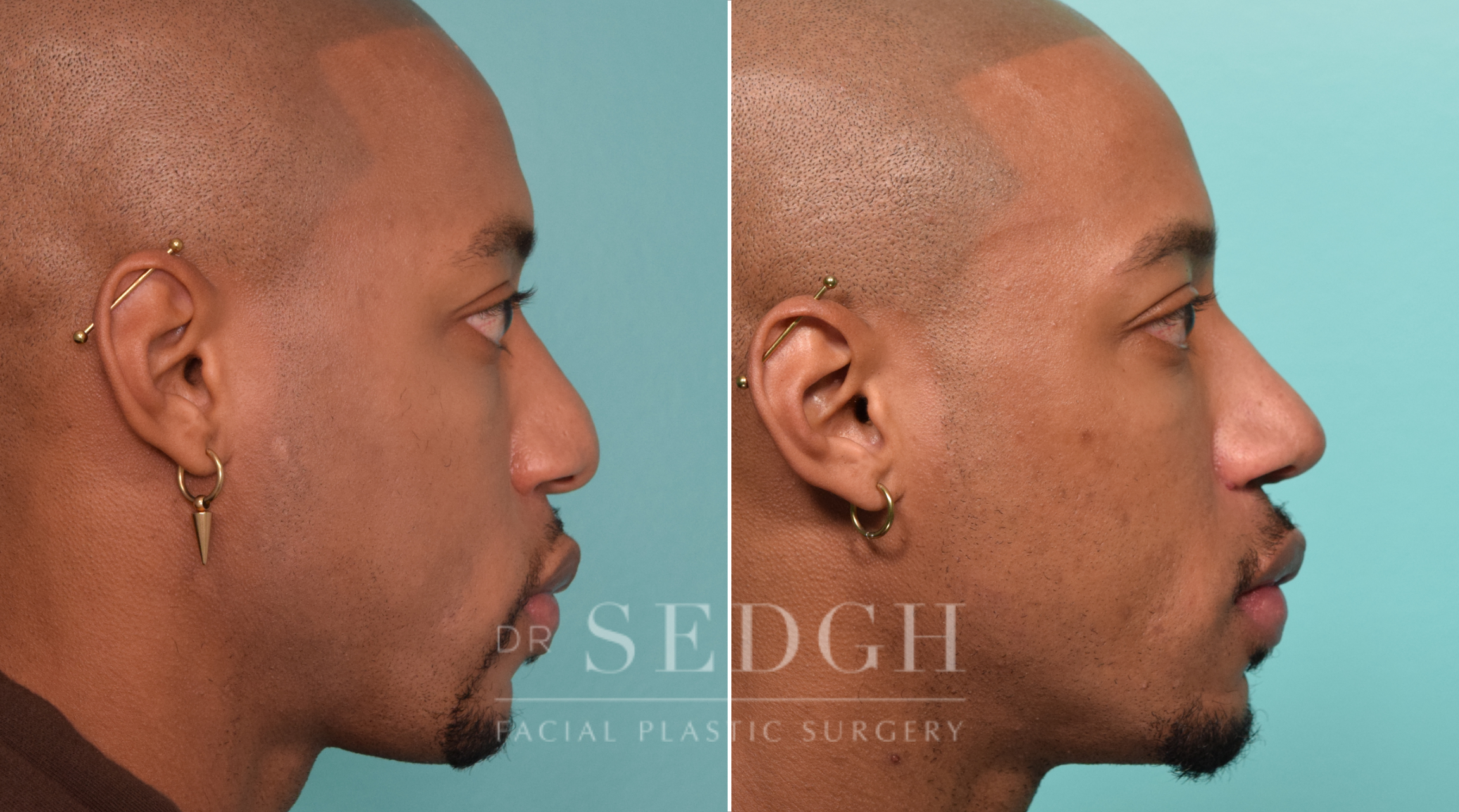 patient before and after rhinoplasty procedure