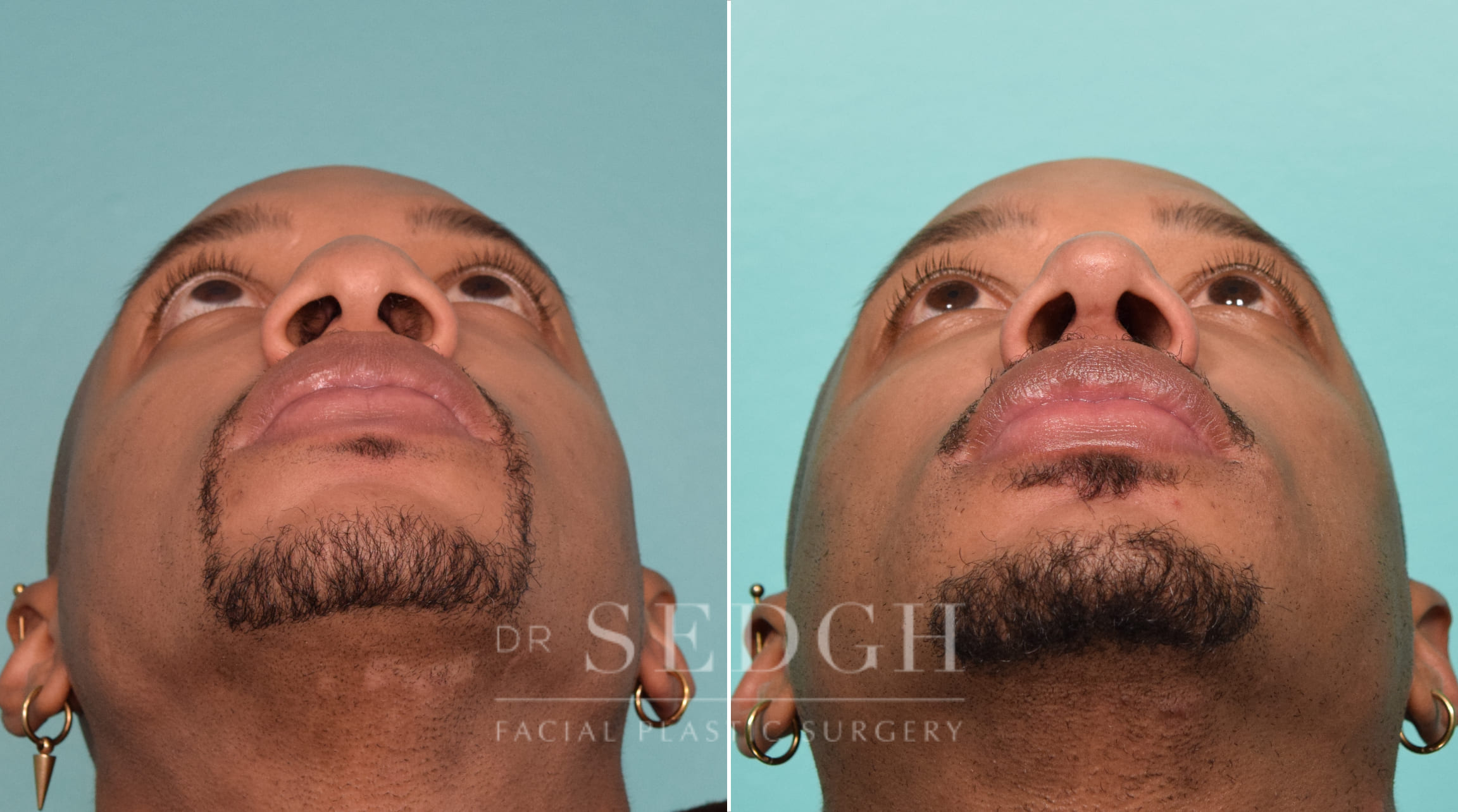 patient before and after rhinoplasty procedure