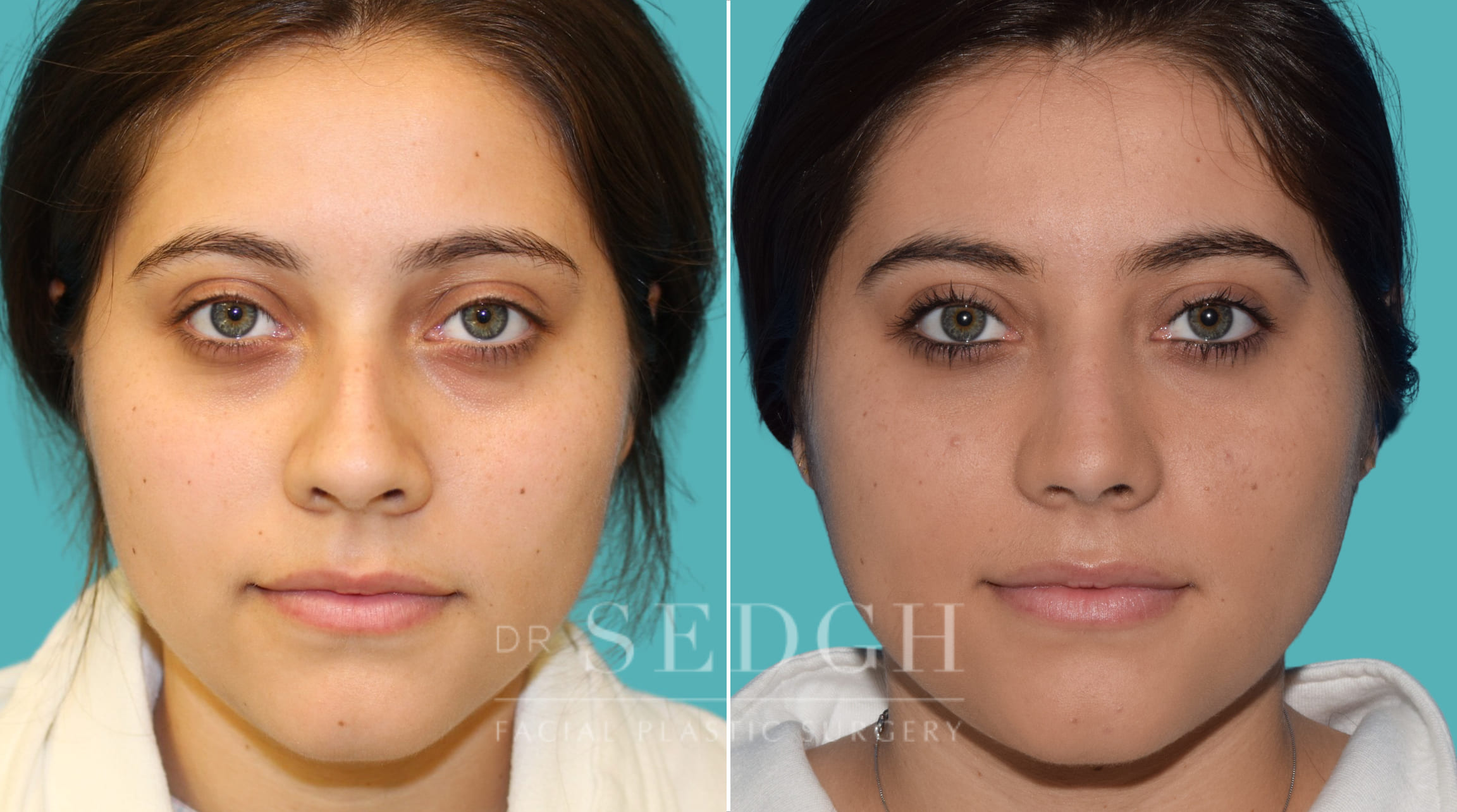 female patient before and after rhinoplasty procedure