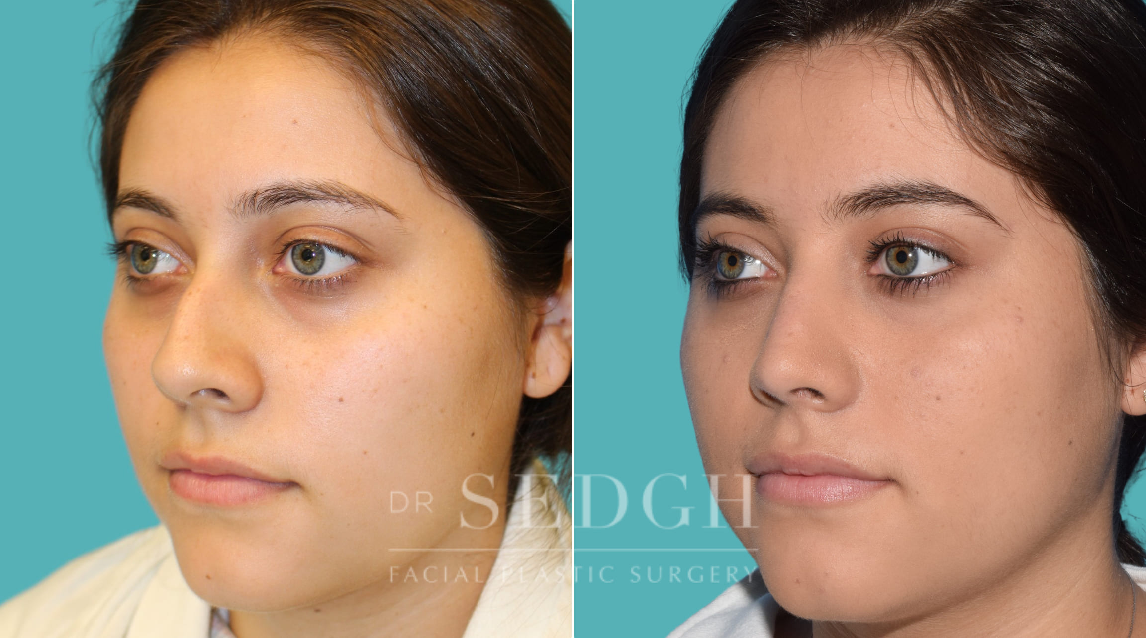 female patient before and after rhinoplasty procedure