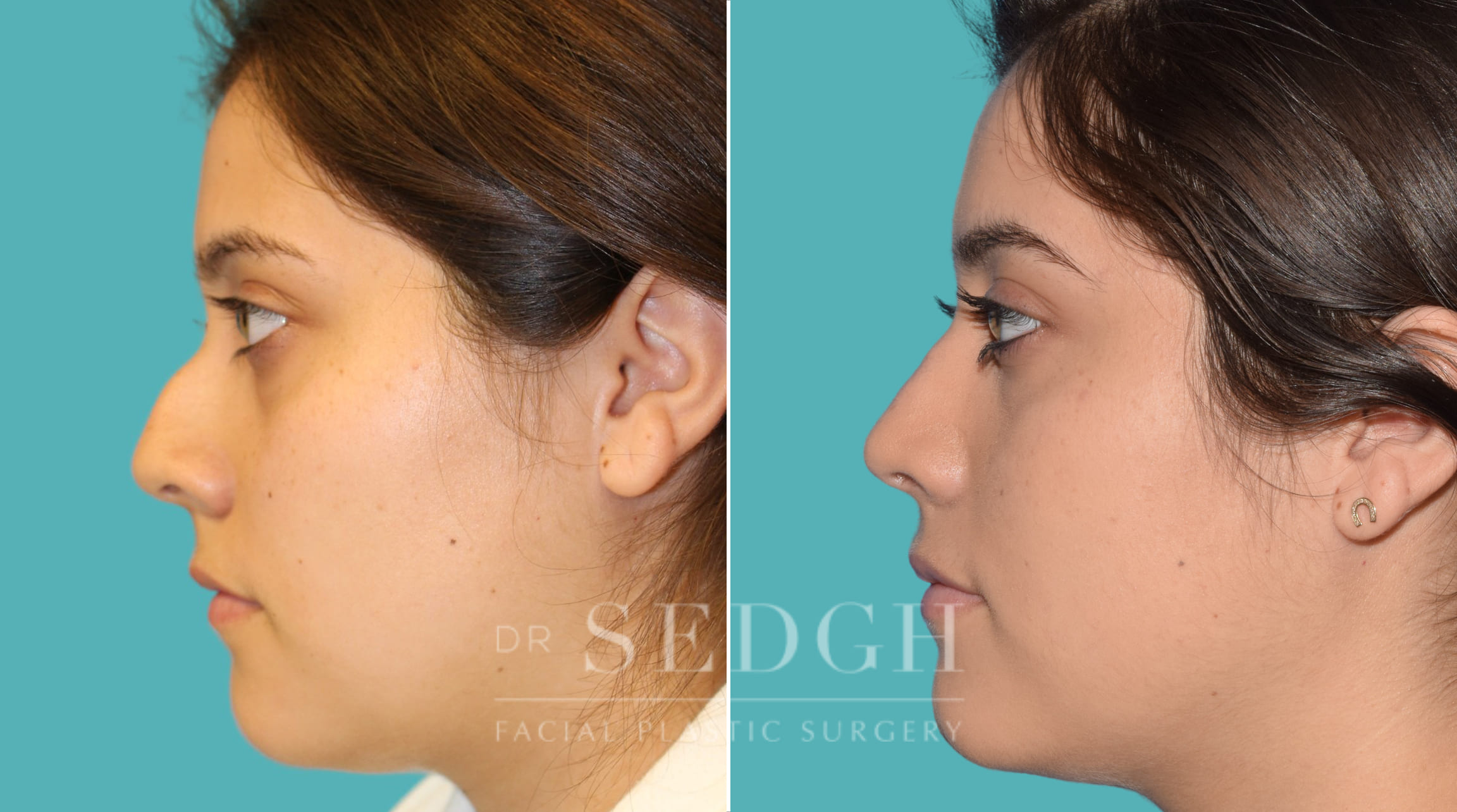 female patient before and after rhinoplasty procedure