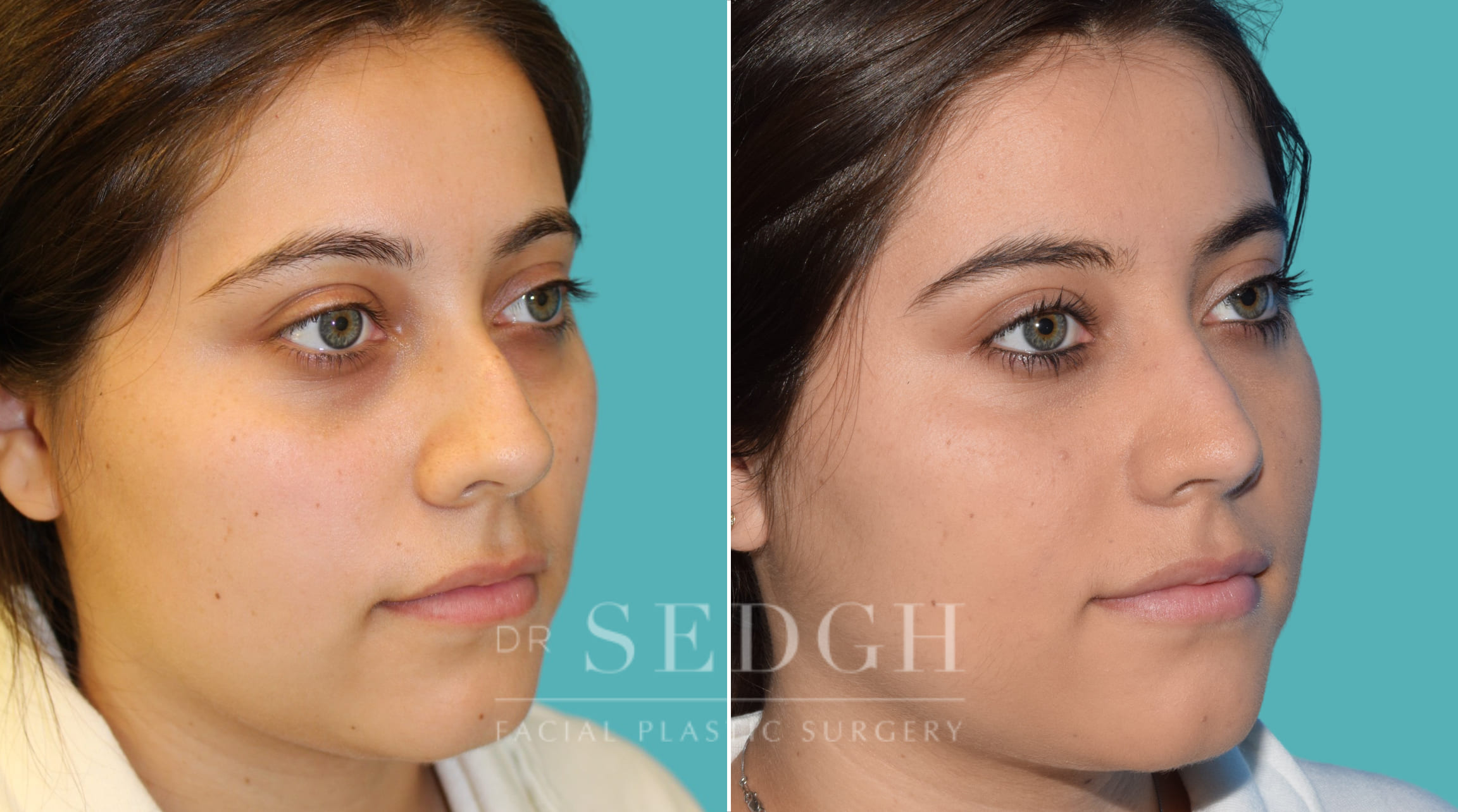 female patient before and after rhinoplasty procedure