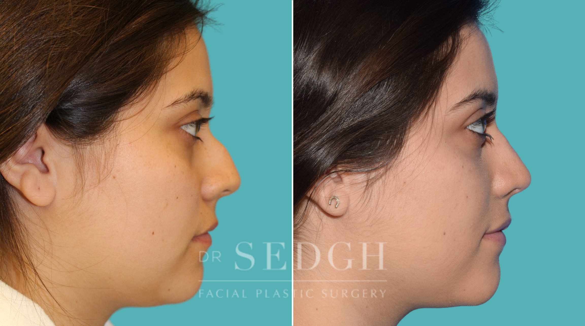 female patient before and after rhinoplasty procedure