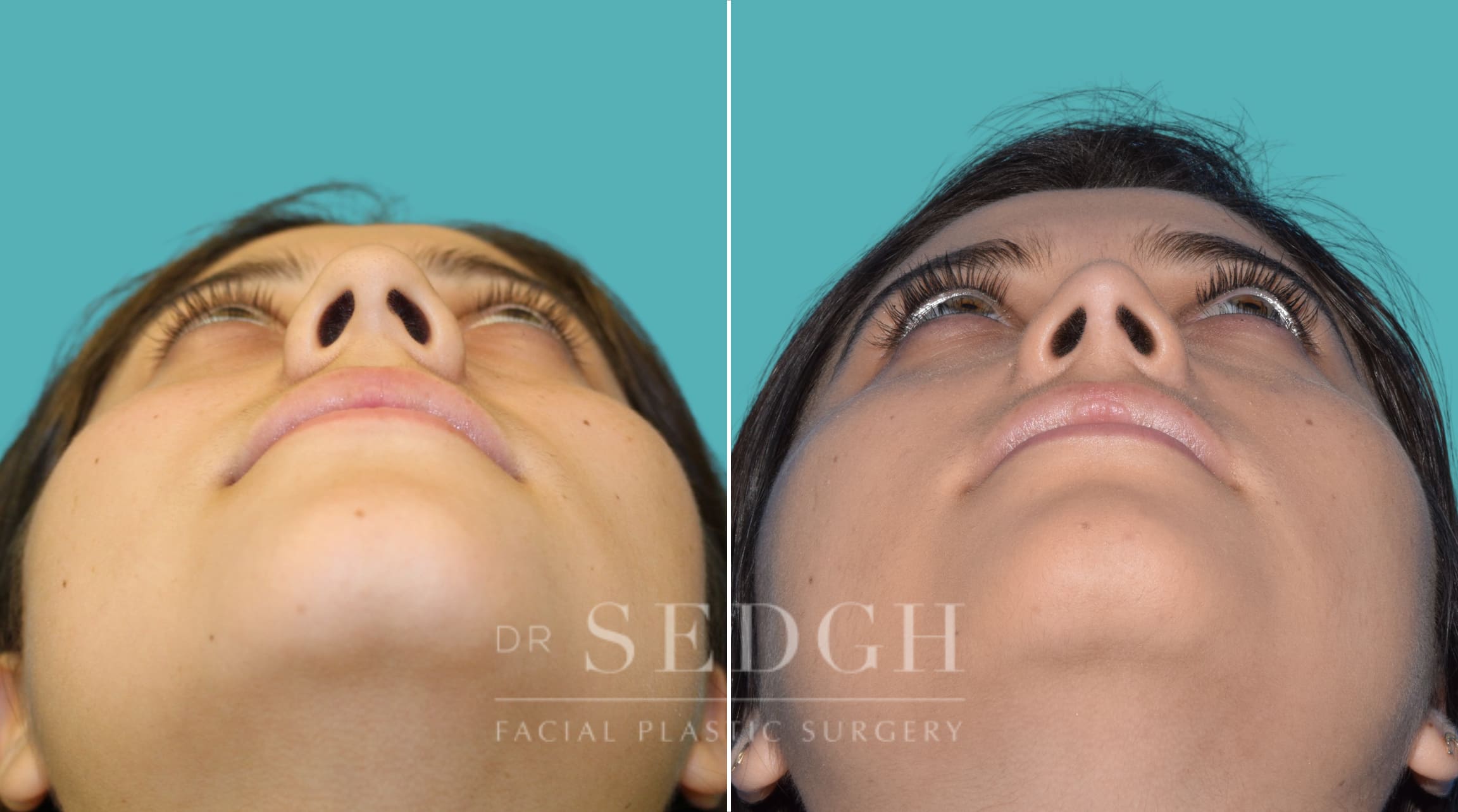 female patient before and after rhinoplasty procedure