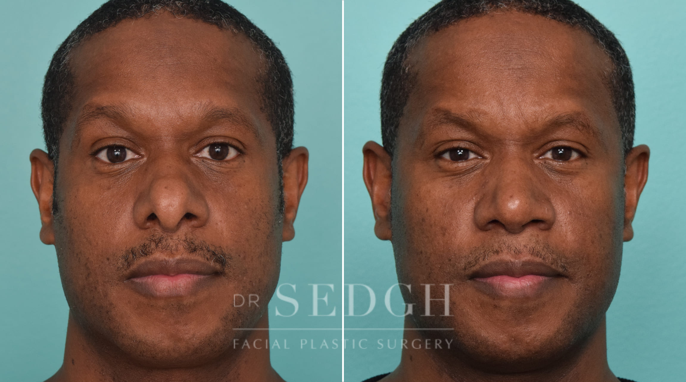 male patient before and after rhinoplasty procedure