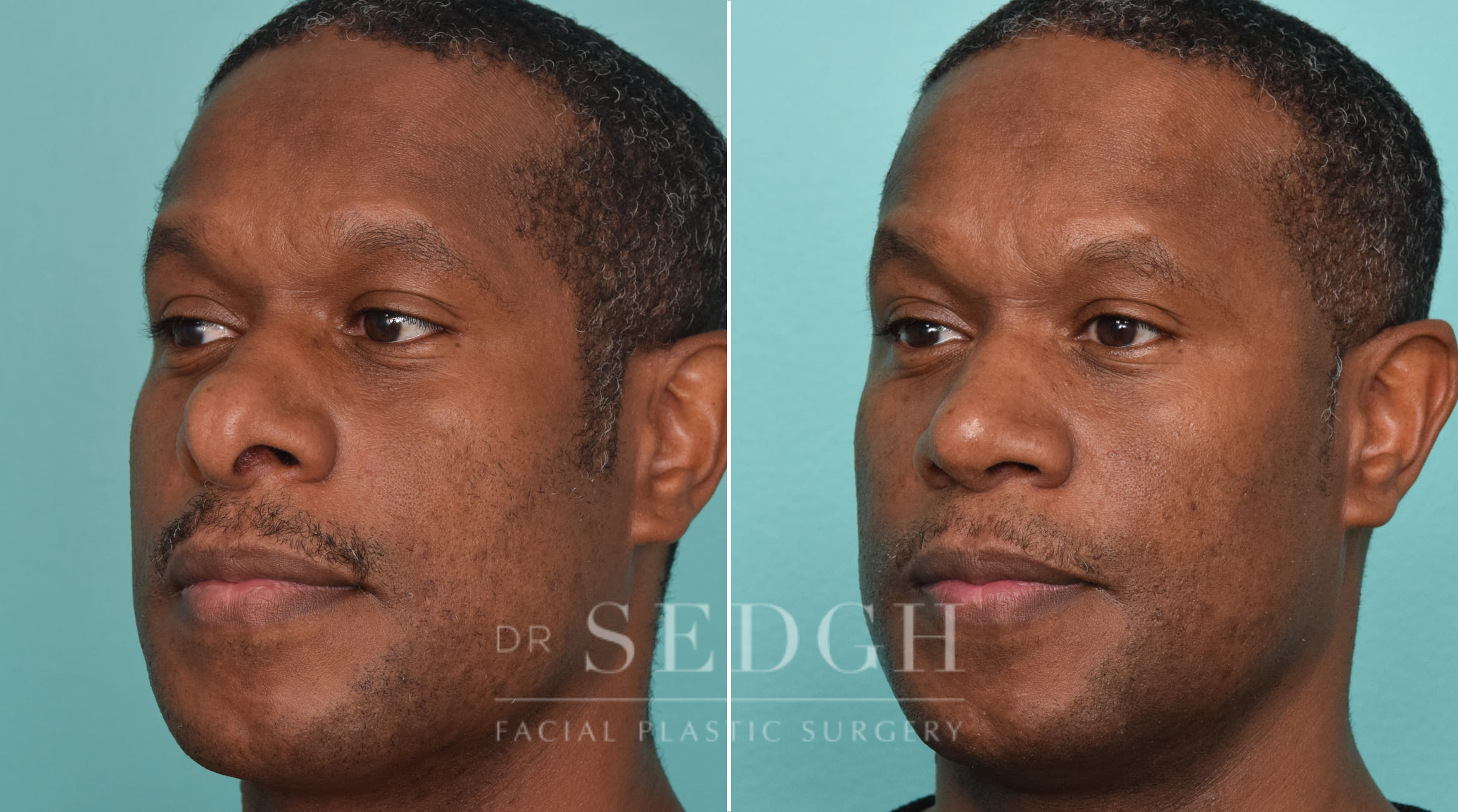 male patient before and after rhinoplasty procedure