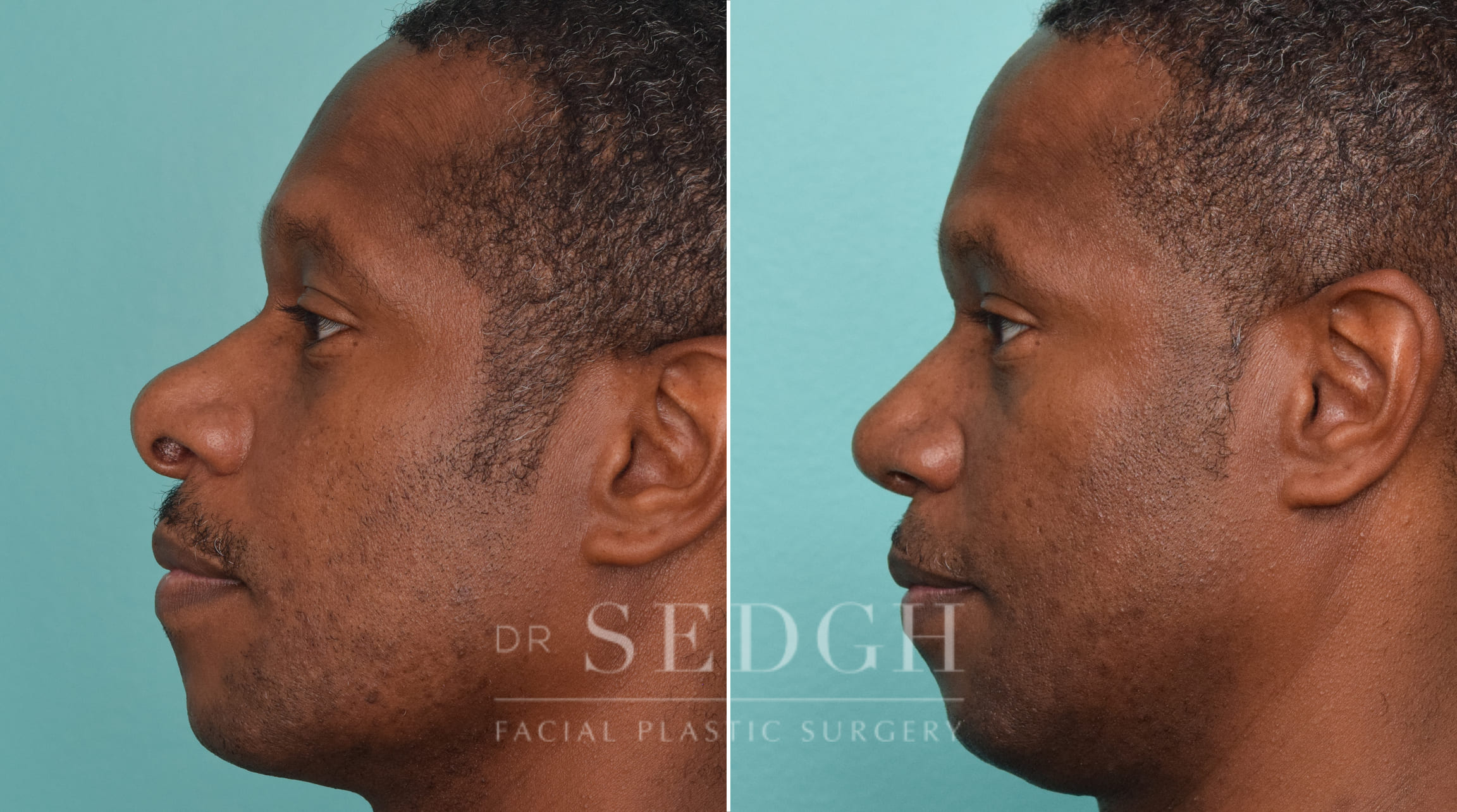 male patient before and after rhinoplasty procedure