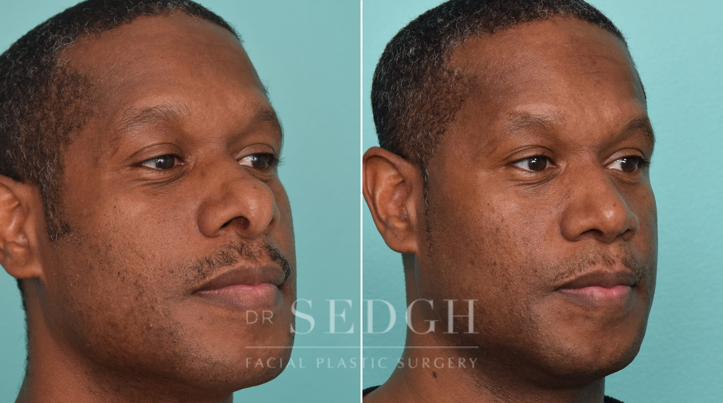 male patient before and after rhinoplasty procedure