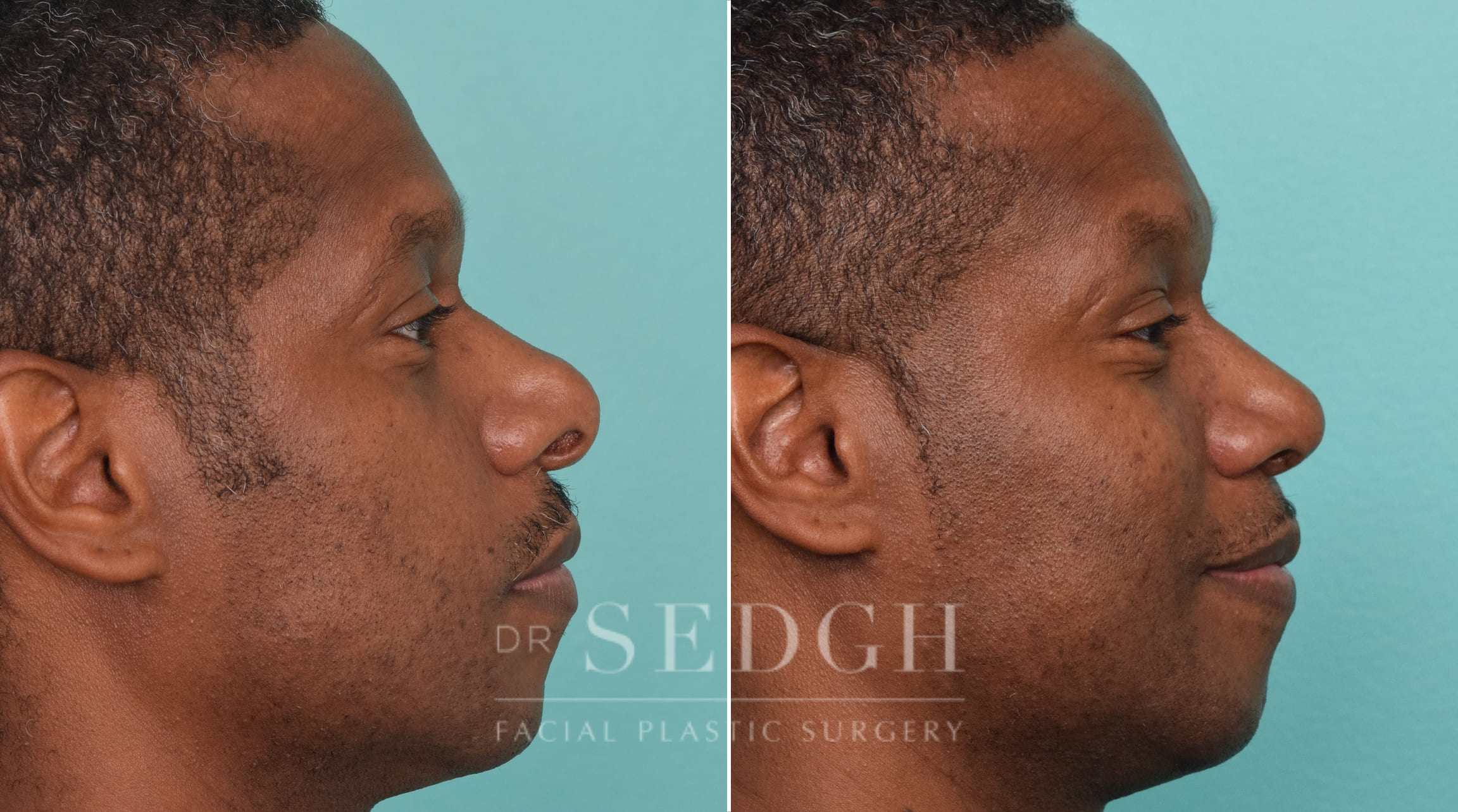 male patient before and after rhinoplasty procedure