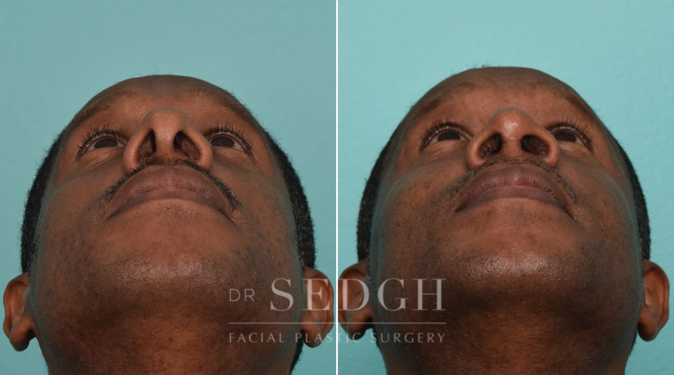 male patient before and after rhinoplasty procedure