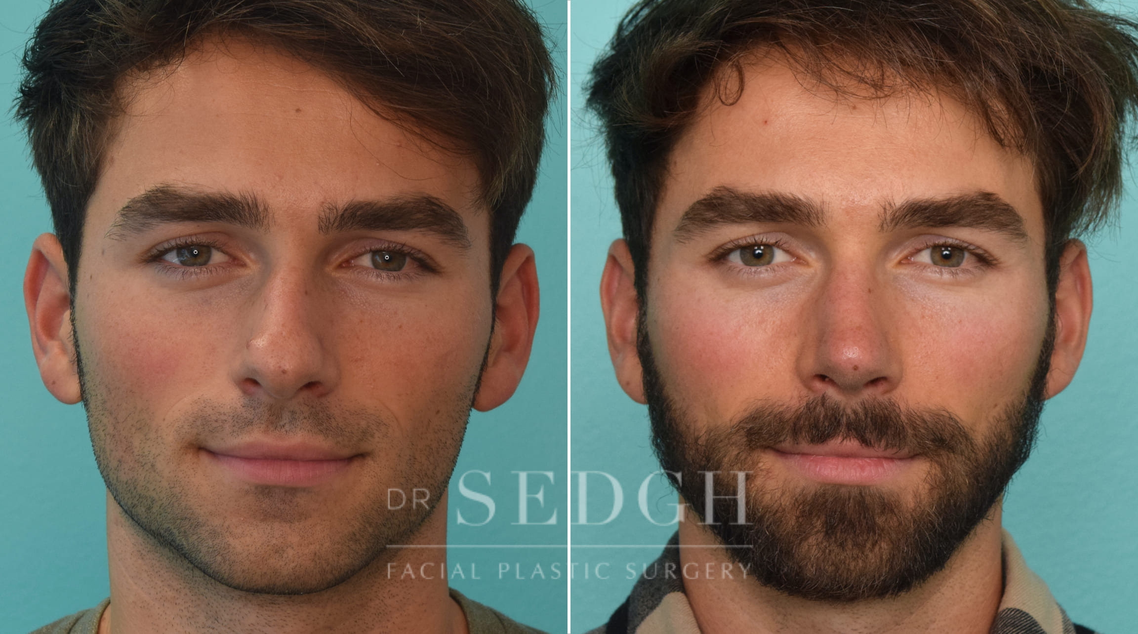 patient before and after rhinoplasty procedure