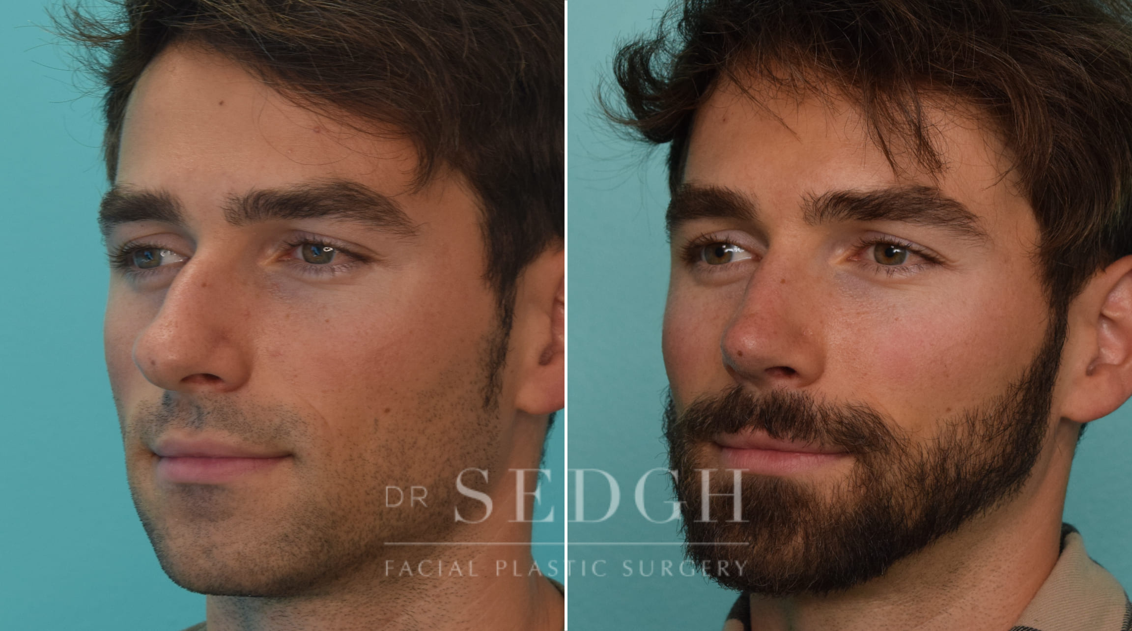 patient before and after rhinoplasty procedure